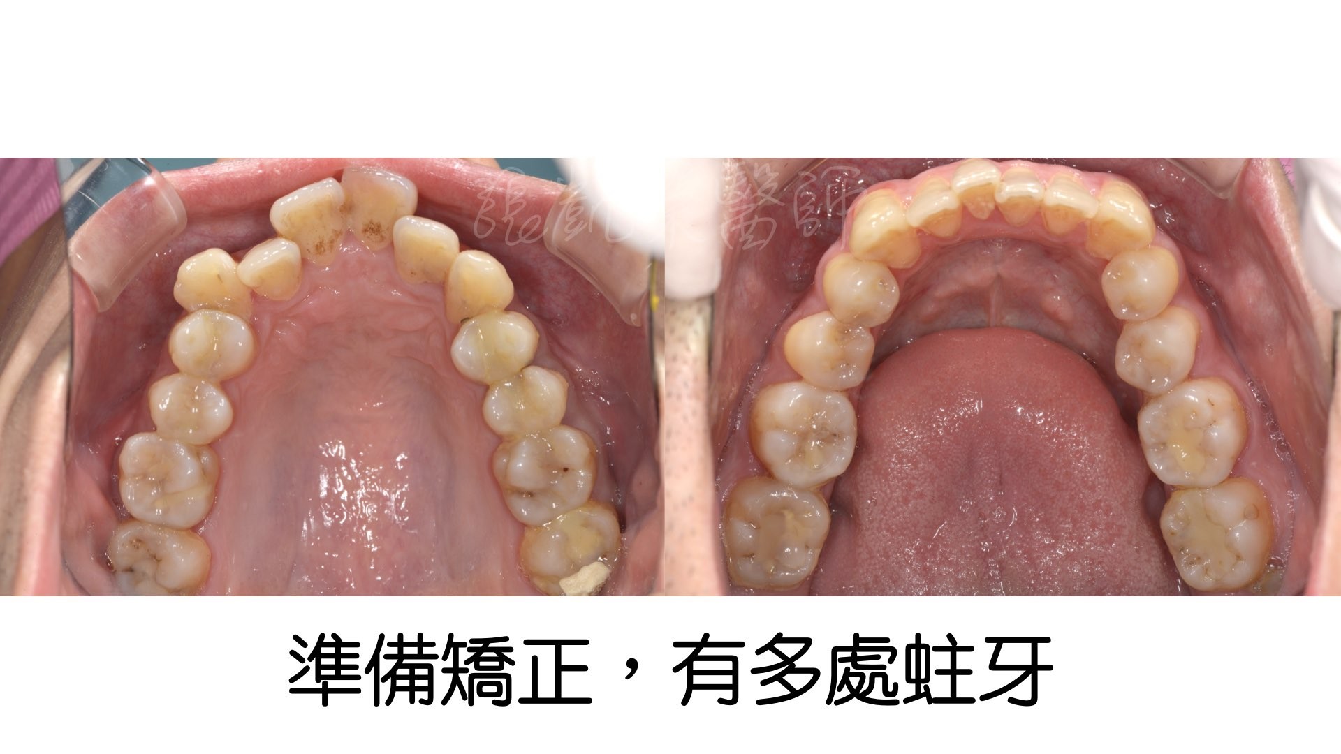 矯正前要注意牙齒什麼問題呢 Part I 疾病治療篇 蛀牙 神經發炎 牙周病 牙科美容資訊 美容牙科張凱榮醫師