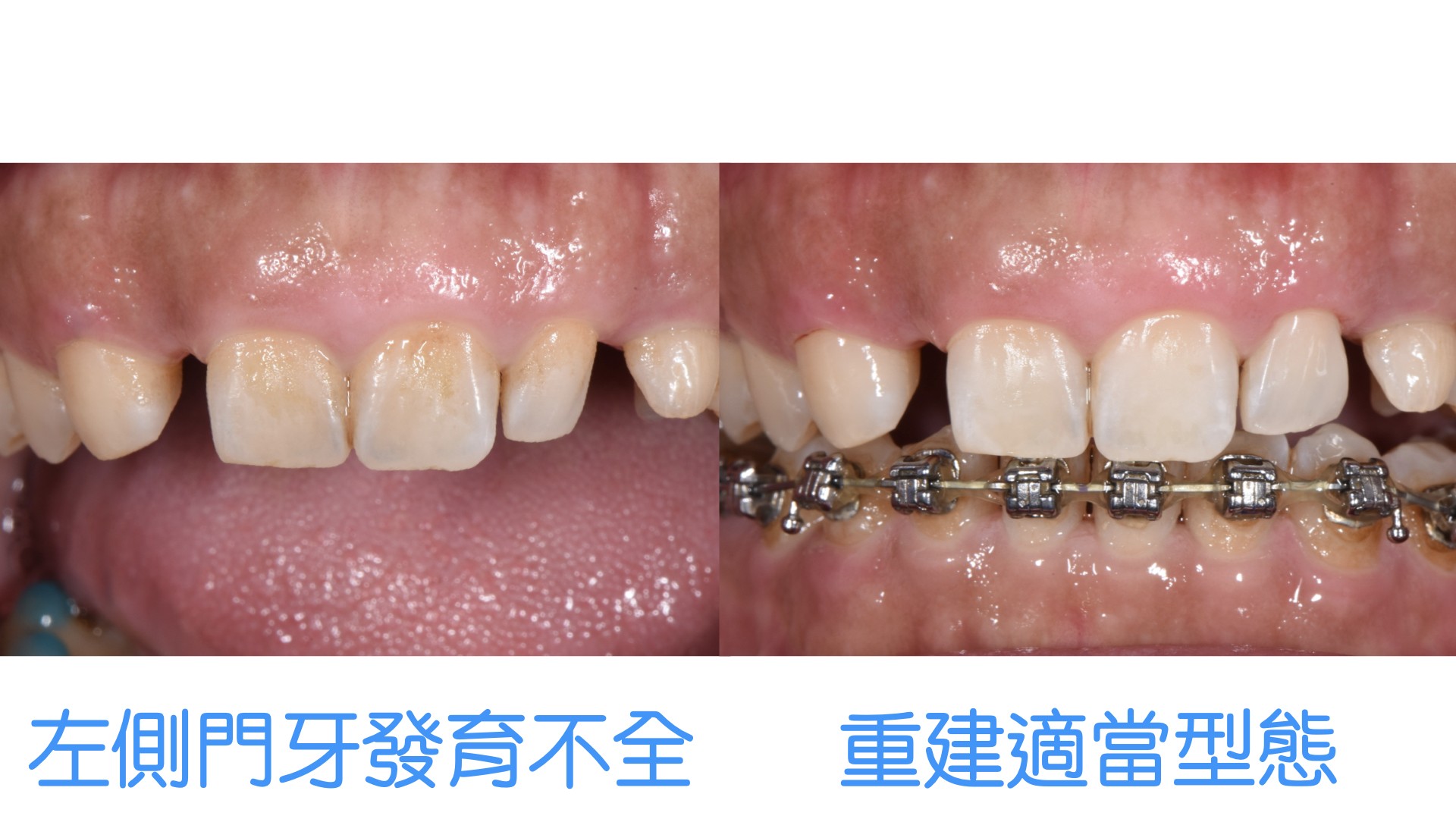 矯正前要注意牙齒什麼問題呢 Part Ii調整牙齒型態 大小 軸向 牙科美容資訊 美容牙科張凱榮醫師