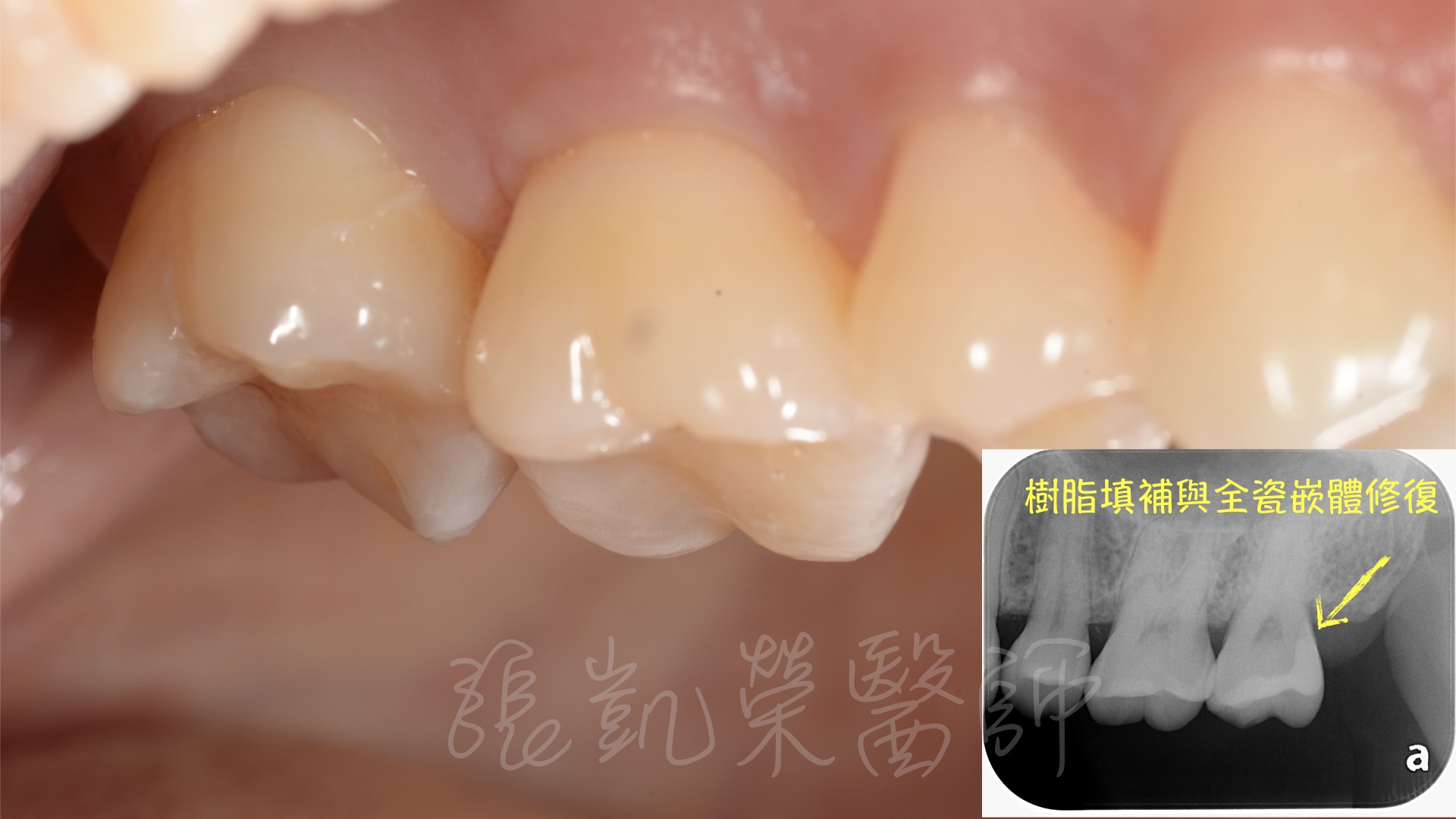 智齒周圍食物阻塞，不易清潔，造成大臼齒後方深部蛀牙，利用樹脂全瓷嵌體修復。