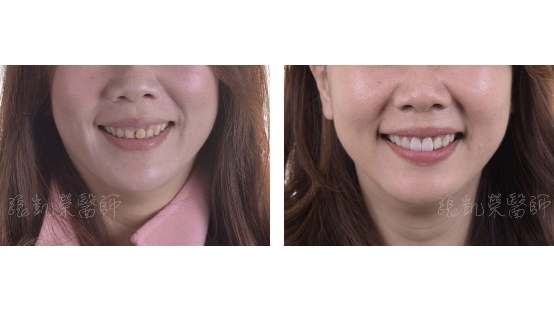 牙冠增長術 part I---改善笑齦的牙齦整形