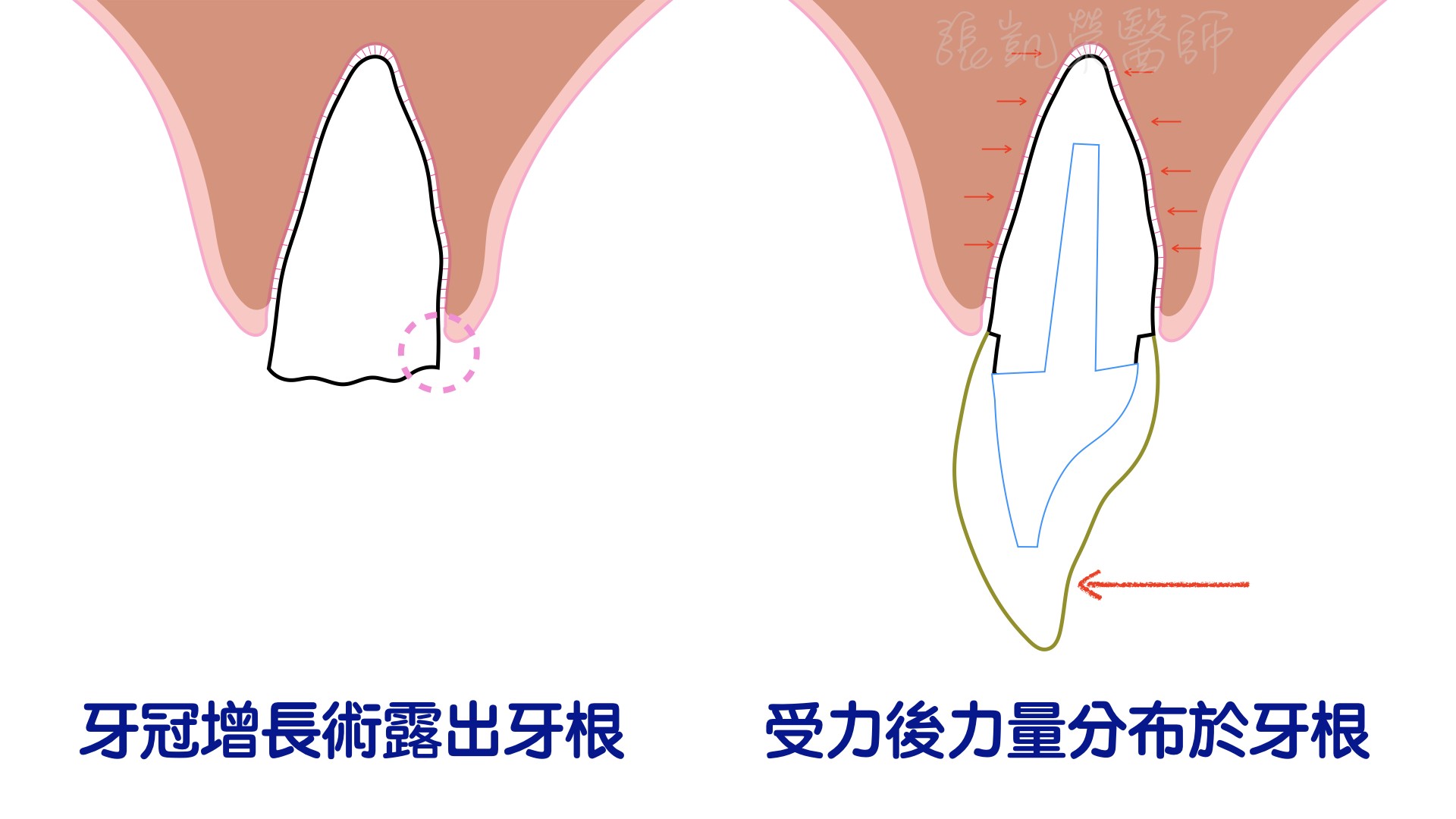 牙冠增長術 part II---拯救牙冠嚴重受傷的牙齒
