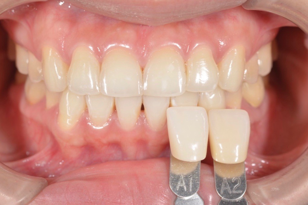 牙齒美白可以美白幾個色階呢？
