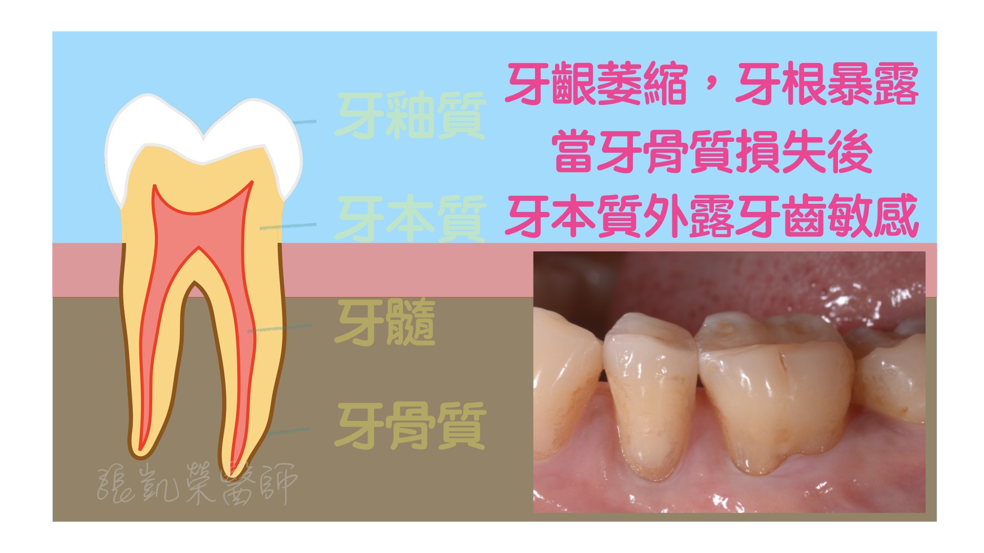 牙齒有酸酸的感覺，牙齒是怎麼了呢？  partII：牙齦萎縮