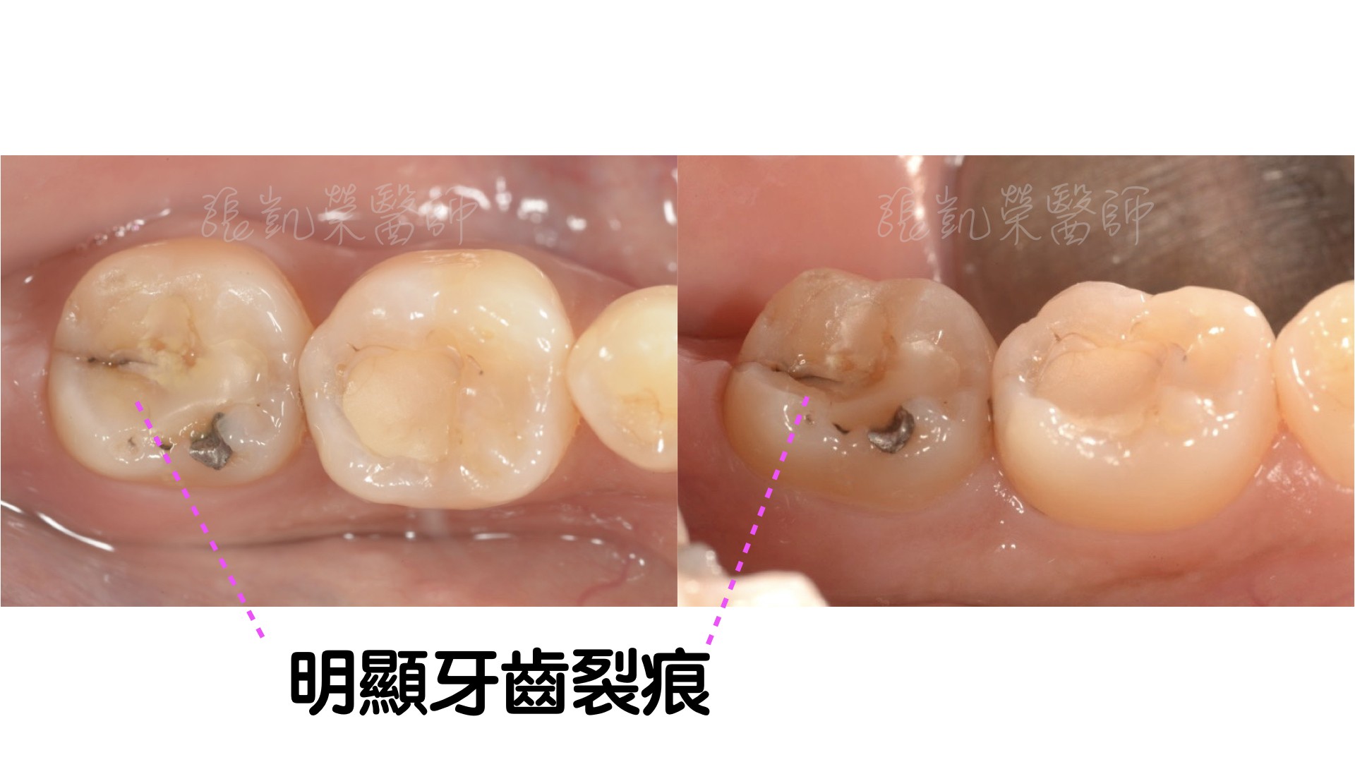 牙科 蔡璧原醫師: 牙齒裂掉了，有什麼治療選擇？part 1