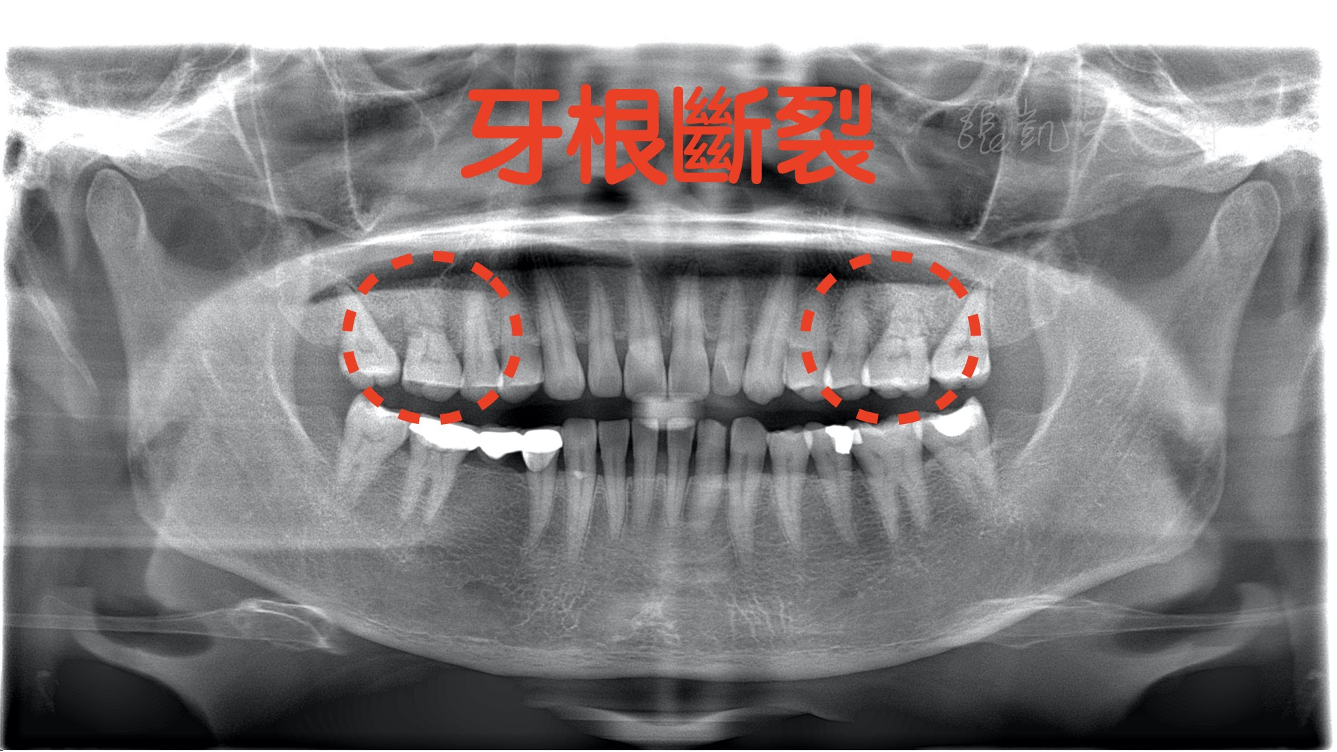 图1-2-33 下颌第一磨牙远中舌根-基础医学-医学