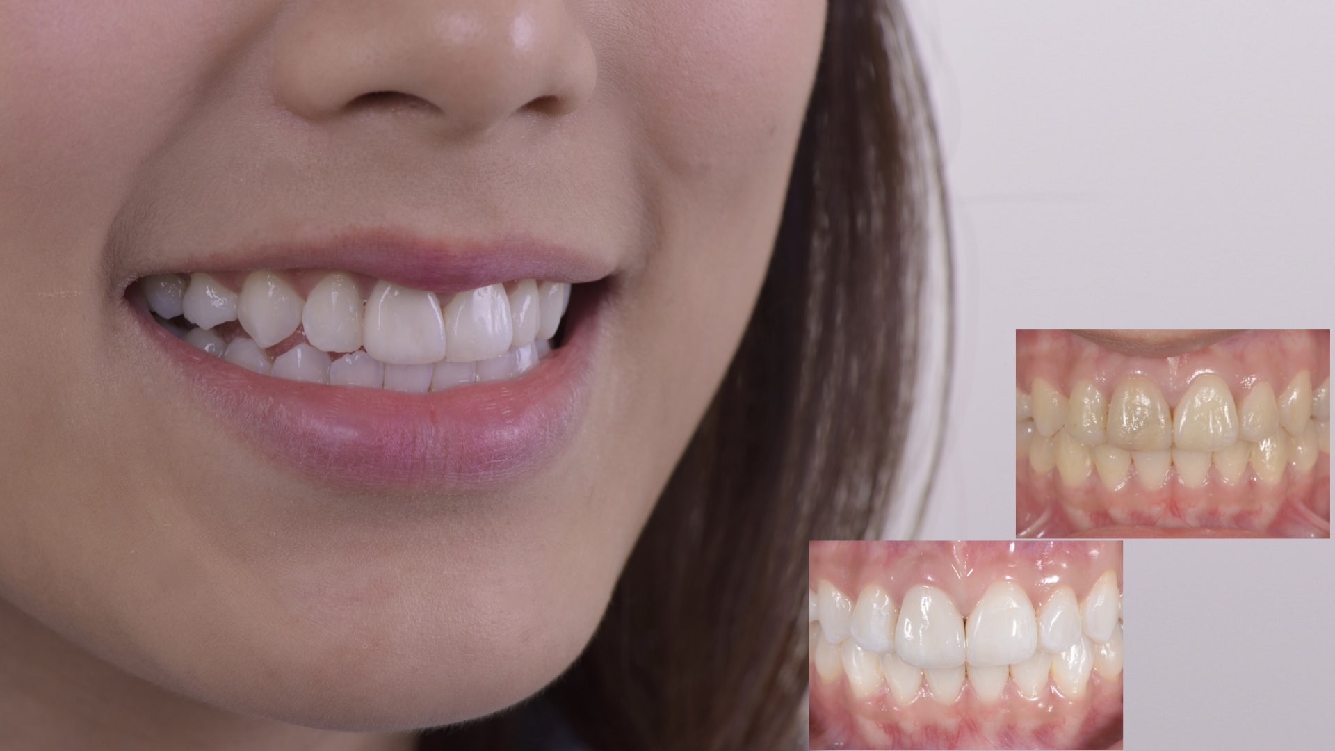 牙齒變黑了怎麼辦？part I：根管治療後，牙齒顏色變深了。