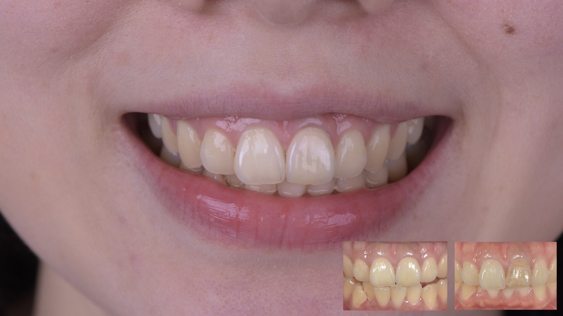 牙齒變黑了怎麼辦？part II：根管治療後，不只牙齒顏色變深，牙齦也黑黑的。