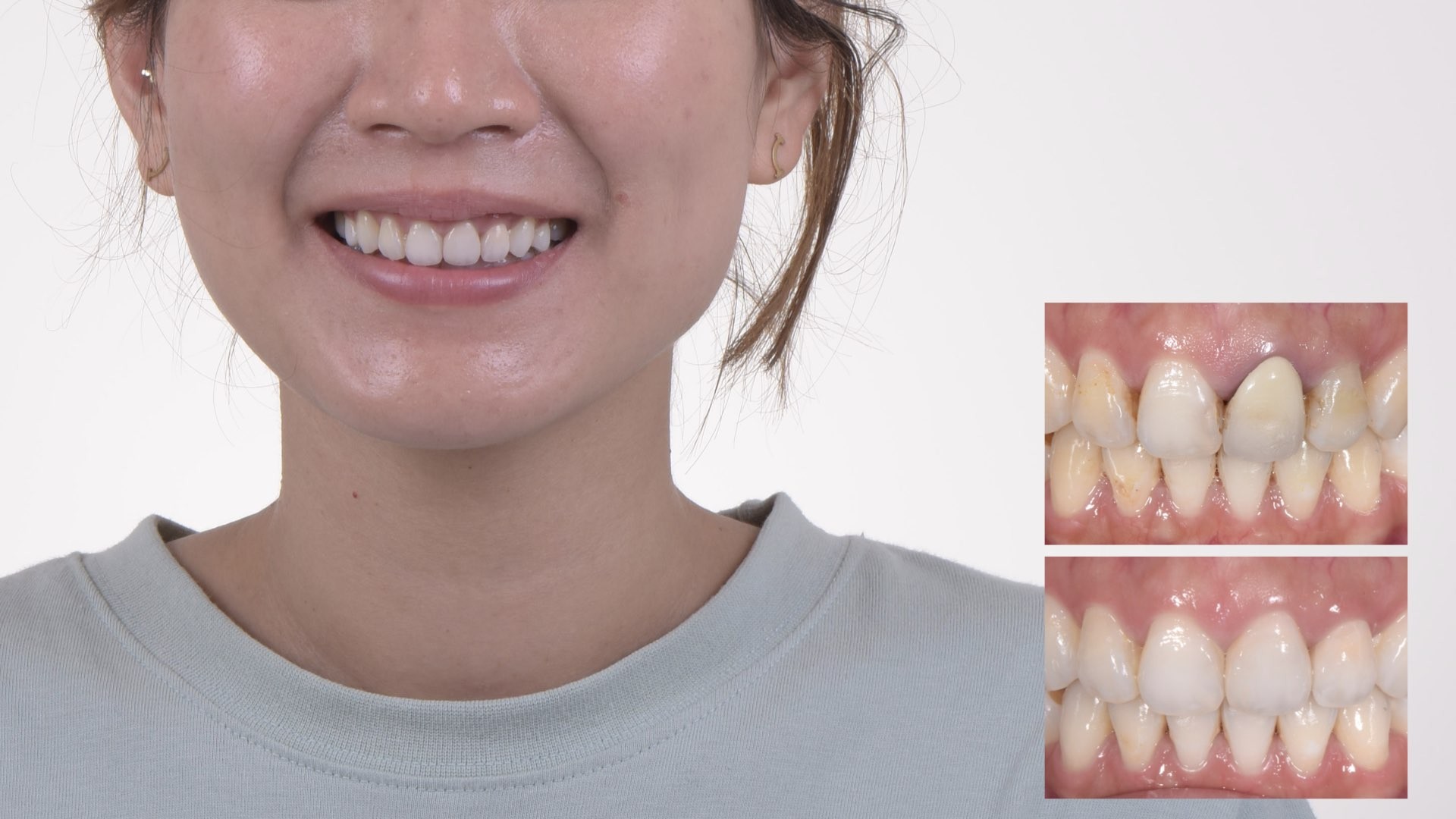 牙齒變黑了怎麼辦？part IV：瓷牙邊緣氧化，造成顏色變深