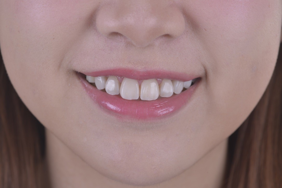 牙齒美白三部曲（二）---牙齒美白有哪幾種？