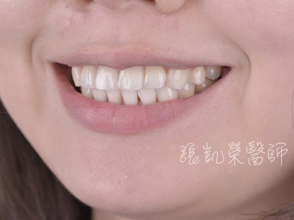 牙齒美白三部曲（三）---牙齒美白步驟