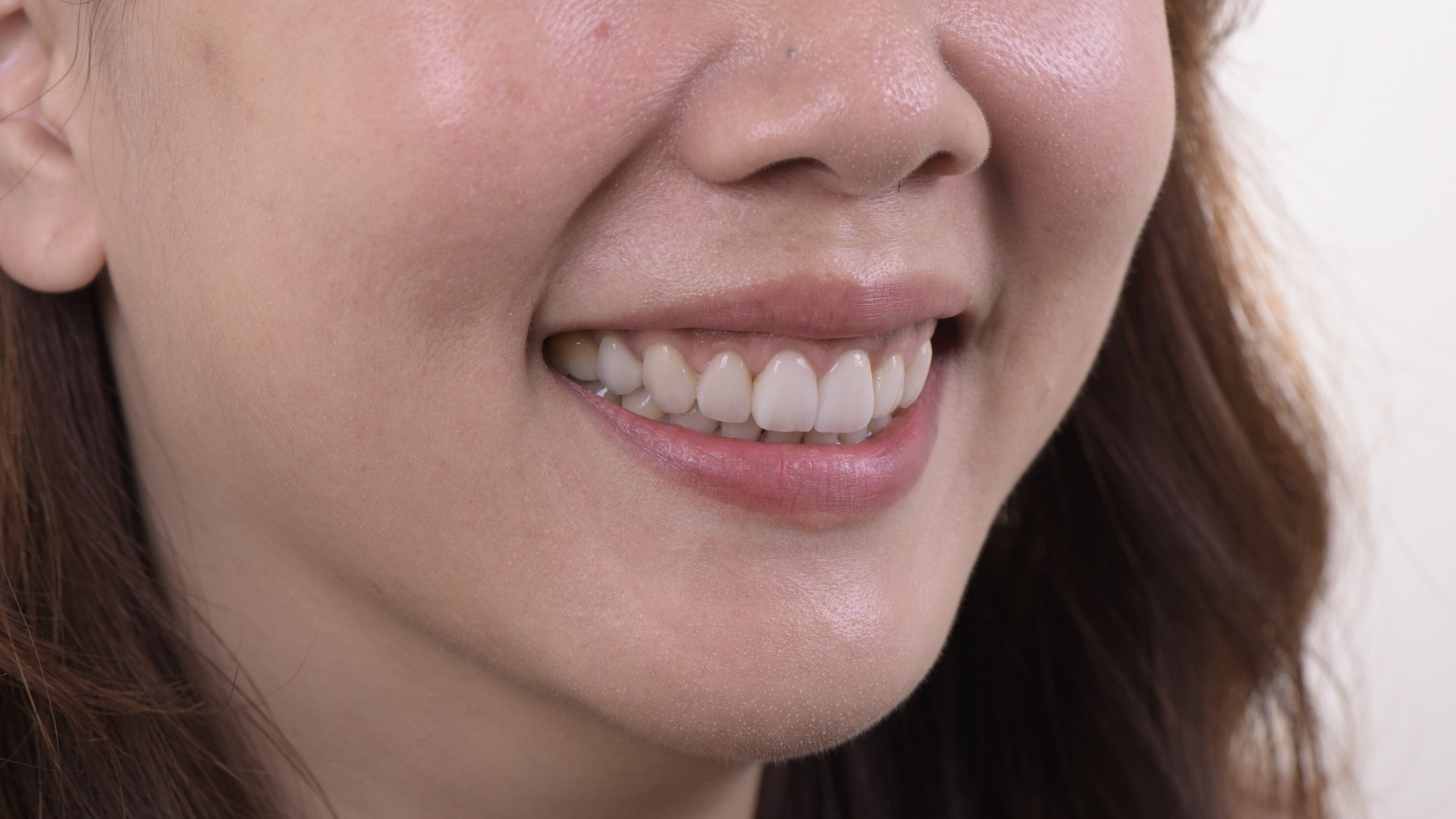 美白全瓷貼片可以不磨牙齒嗎？