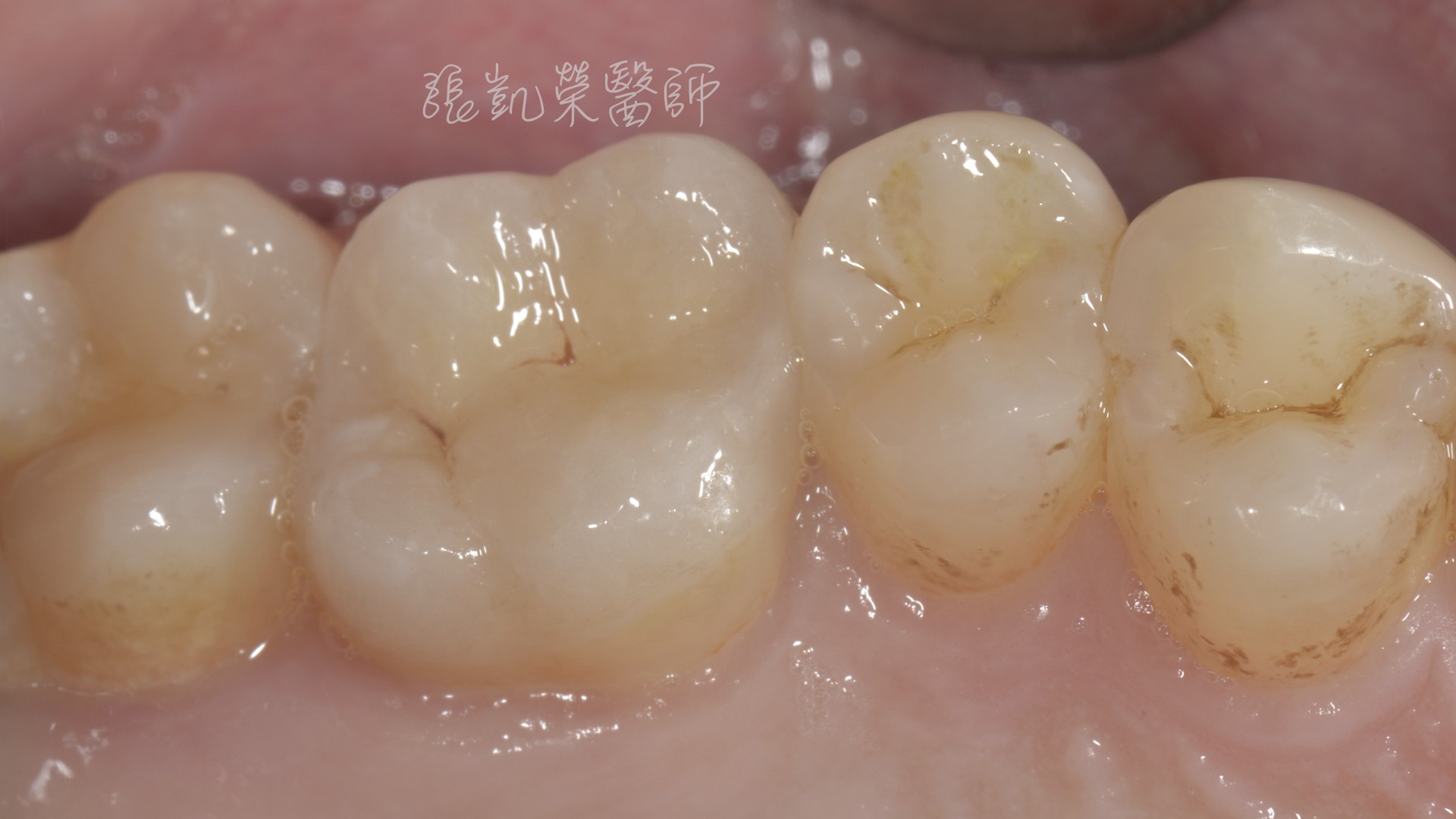 牙齒斷裂怎麼辦？---顯微貼片微創修復 - 案例介紹 - 美容牙科張凱榮醫師
