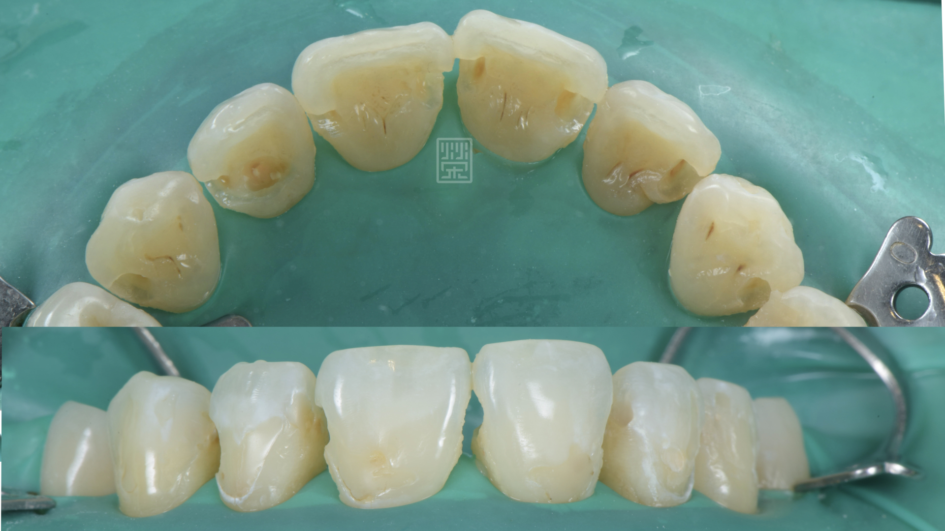 矯正前先把蛀牙與舊天補物清除,確認齲齒病灶已經治療完成