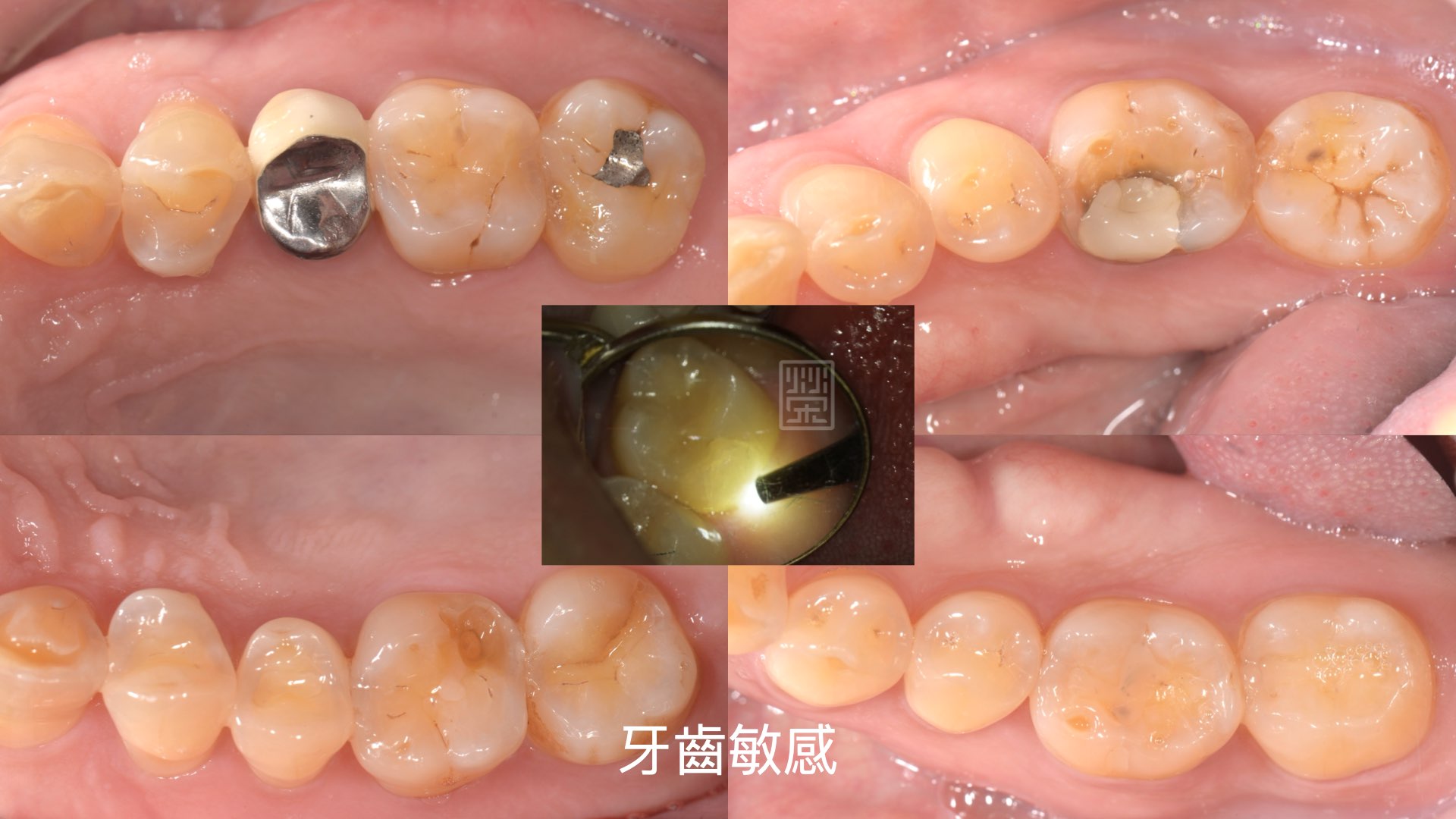 後牙多處牙磨至牙釉質穿透，牙本質露出