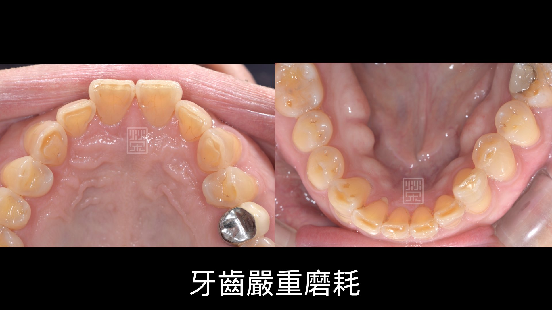 前牙切端牙釉質都穿透，中間牙本質露出來