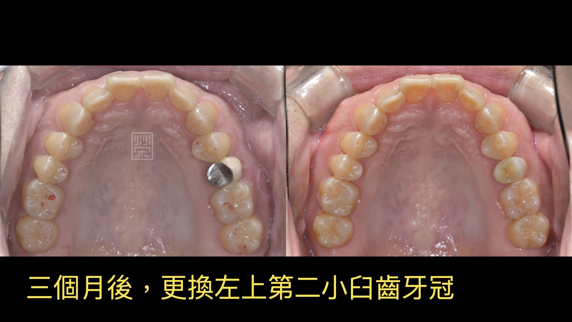 等待咬合穩定後，更換牙套