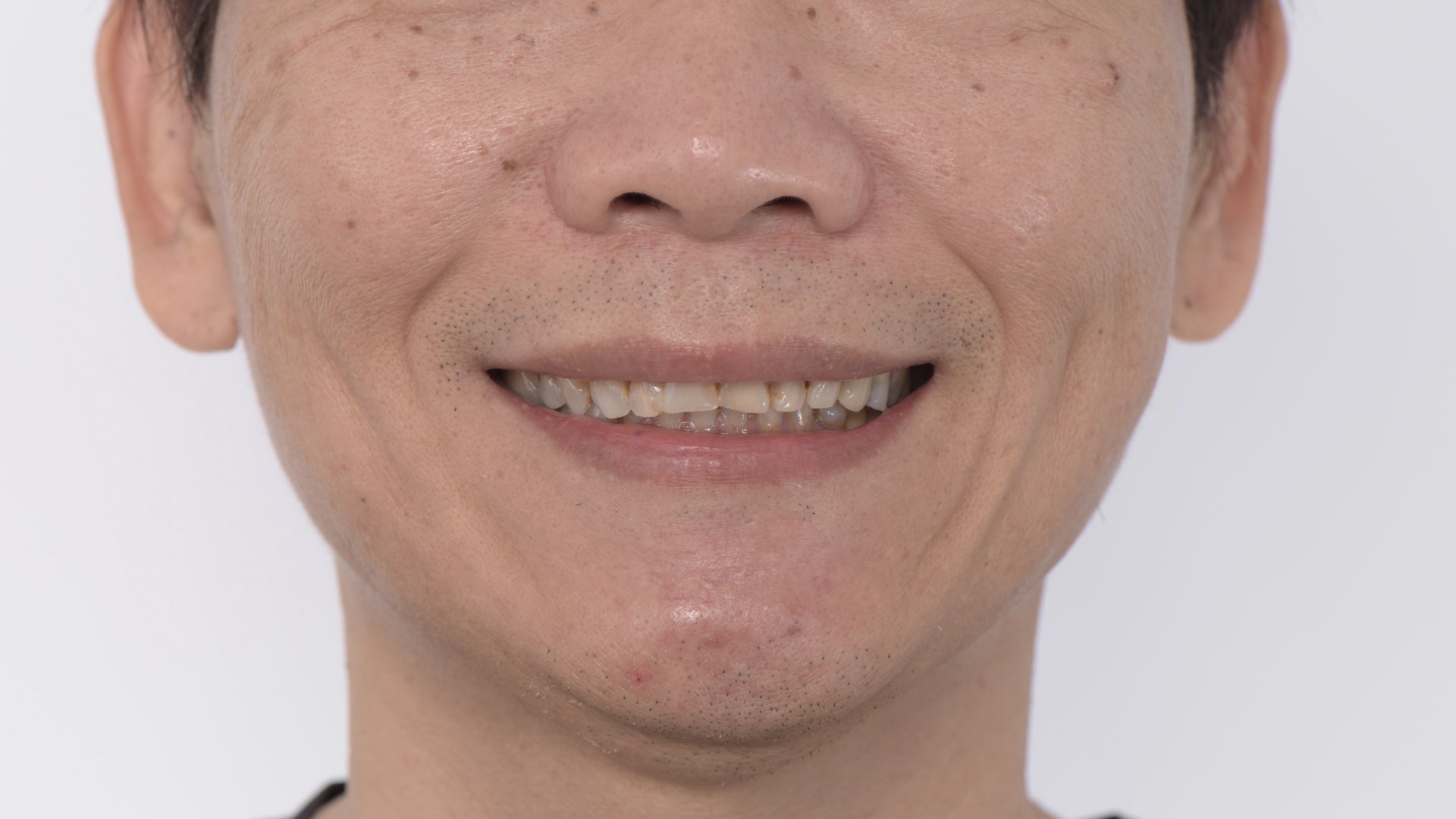 牙齒磨耗明顯