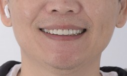 牙齒顏色比較深，又有樹脂填補，要怎麼處理呢？------矯正合併全瓷冠貼片