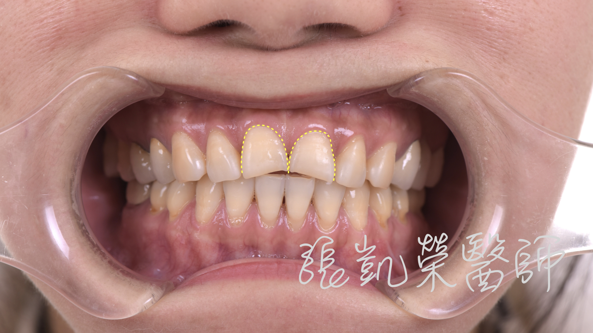 牙齦高低不齊，影響牙齒型態