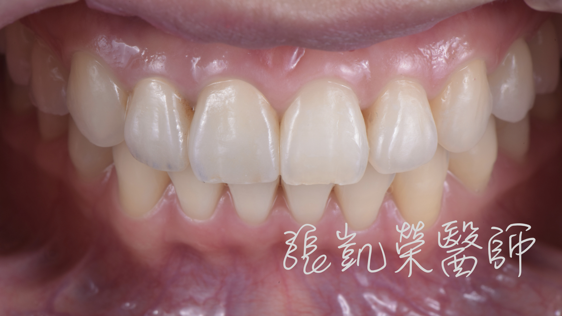 晶湛牙醫診所: E-max 全瓷冠