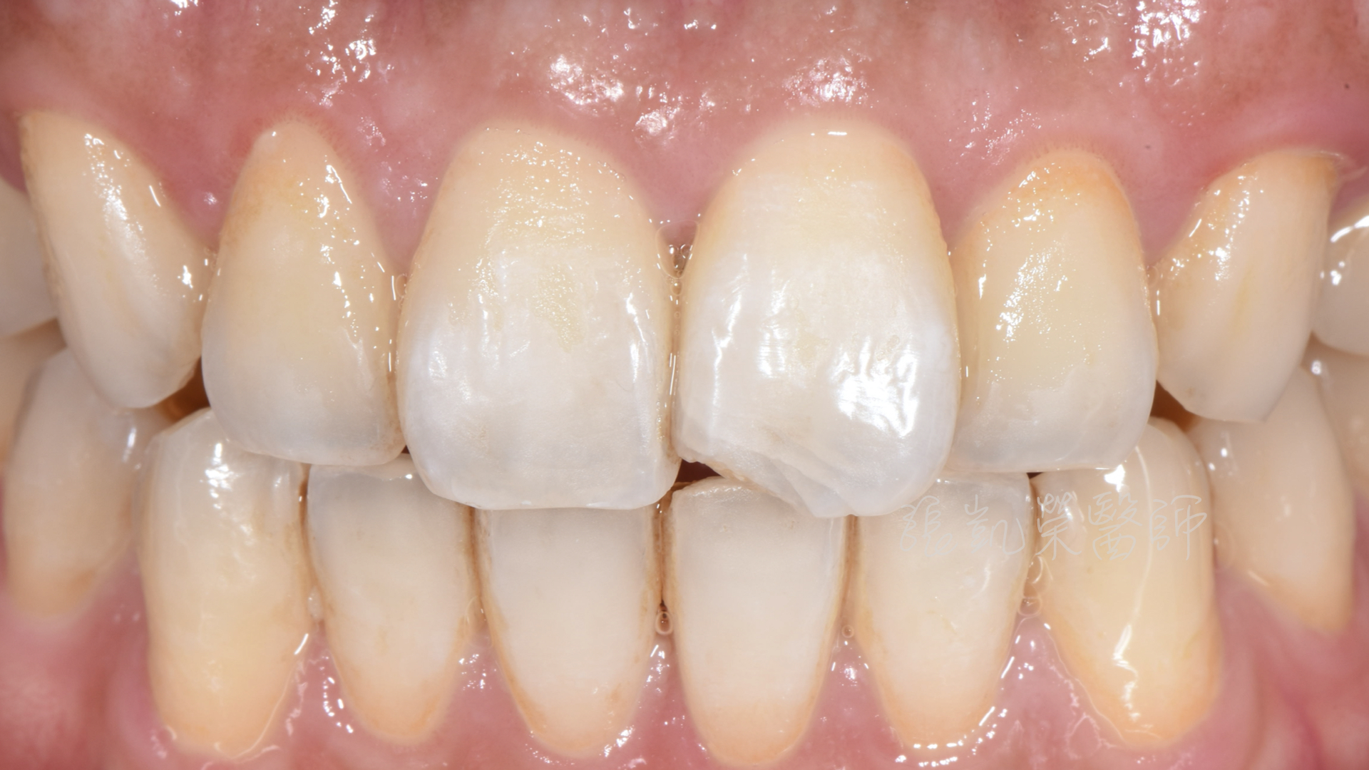 牙齿出现裂纹是什么原因？应该怎么处理？ - 知乎