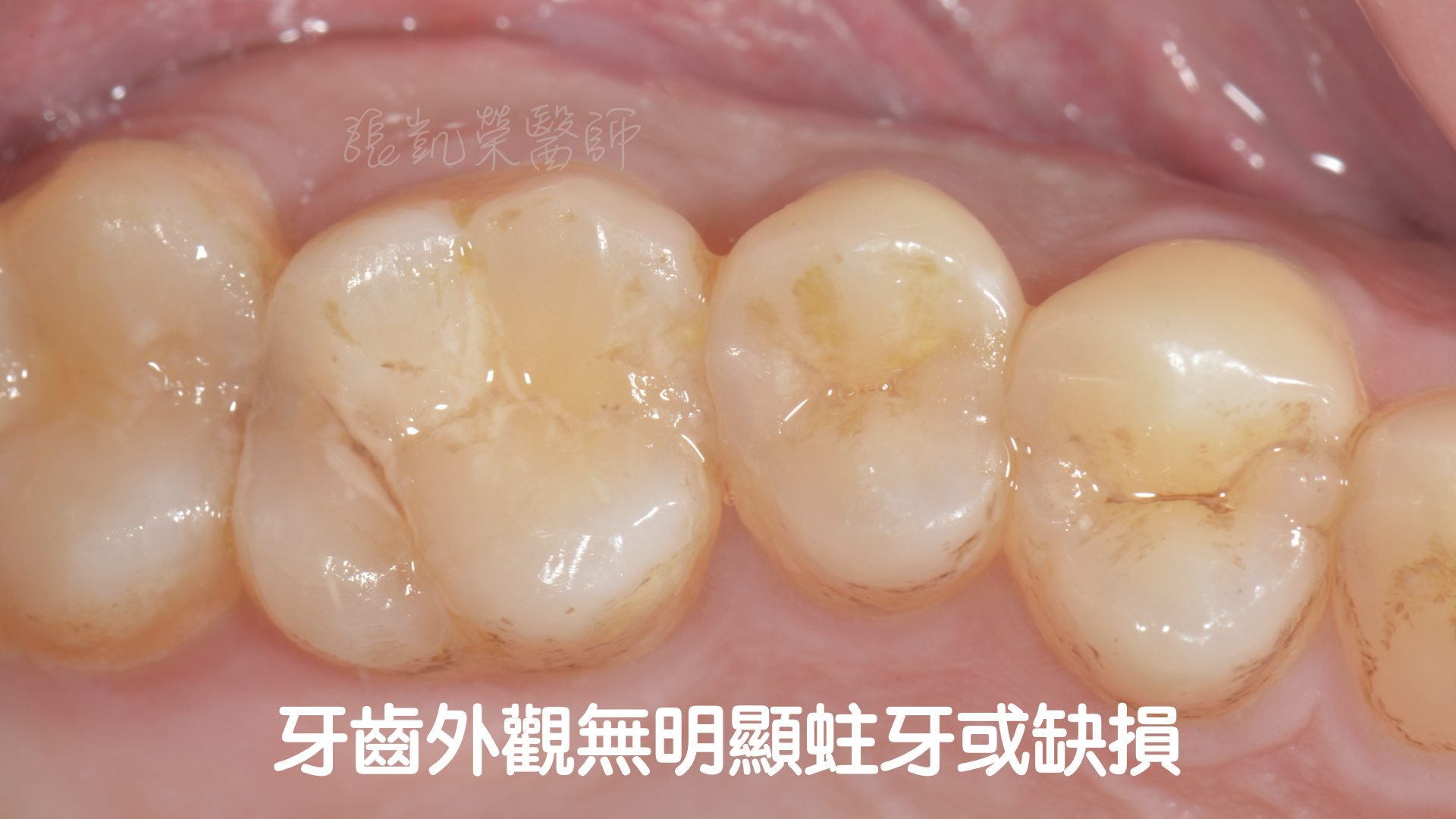 牙齒咬起來酸酸的---牙齒裂了 - 案例介紹 - 美容牙科張凱榮醫師