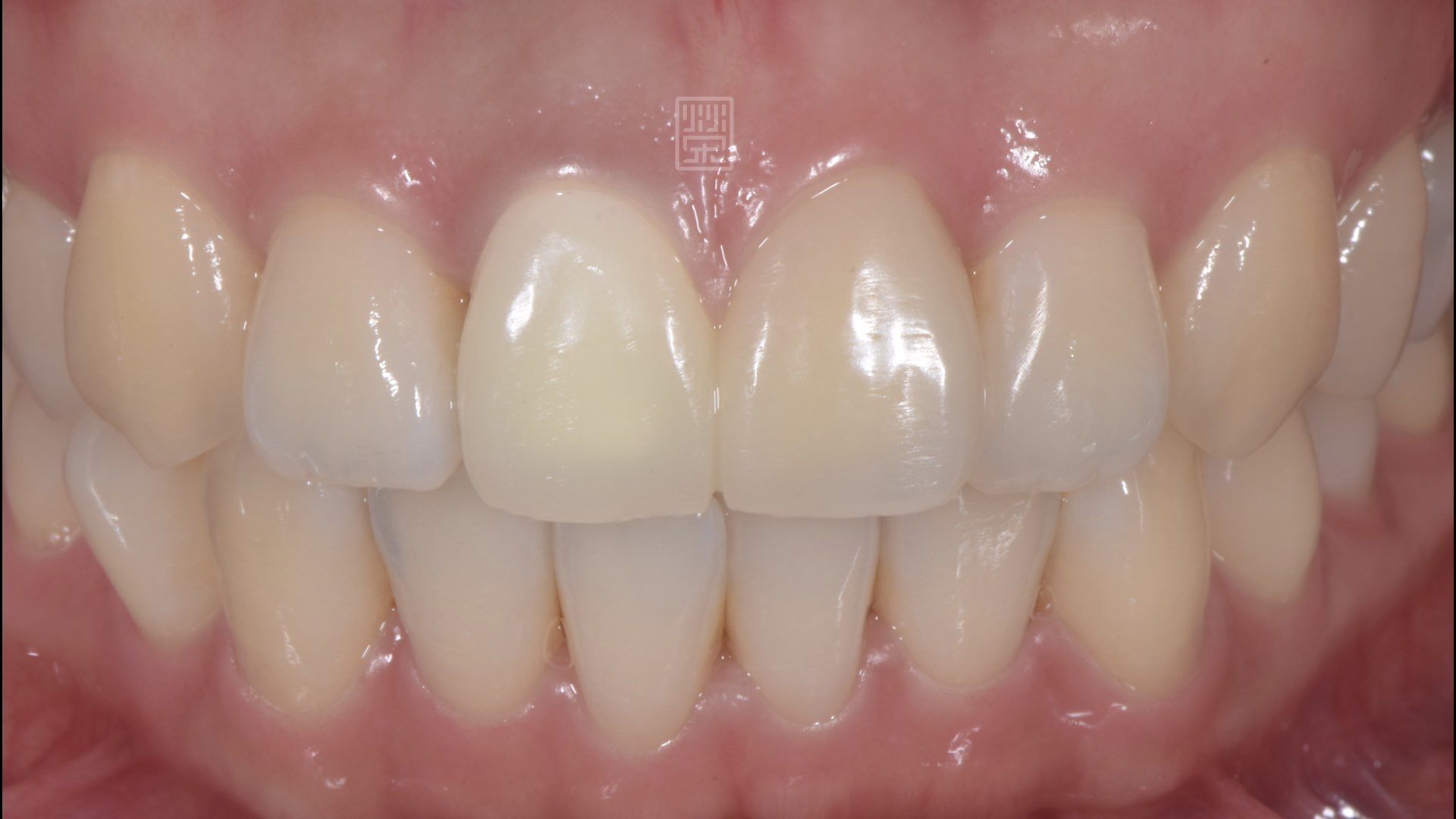 臨時假牙測試型態與豐隆度