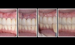 牙齦邊緣萎縮，瓷牙冠邊緣變黑，橋體下牙齦萎縮————全瓷牙橋併牙齦移植手術