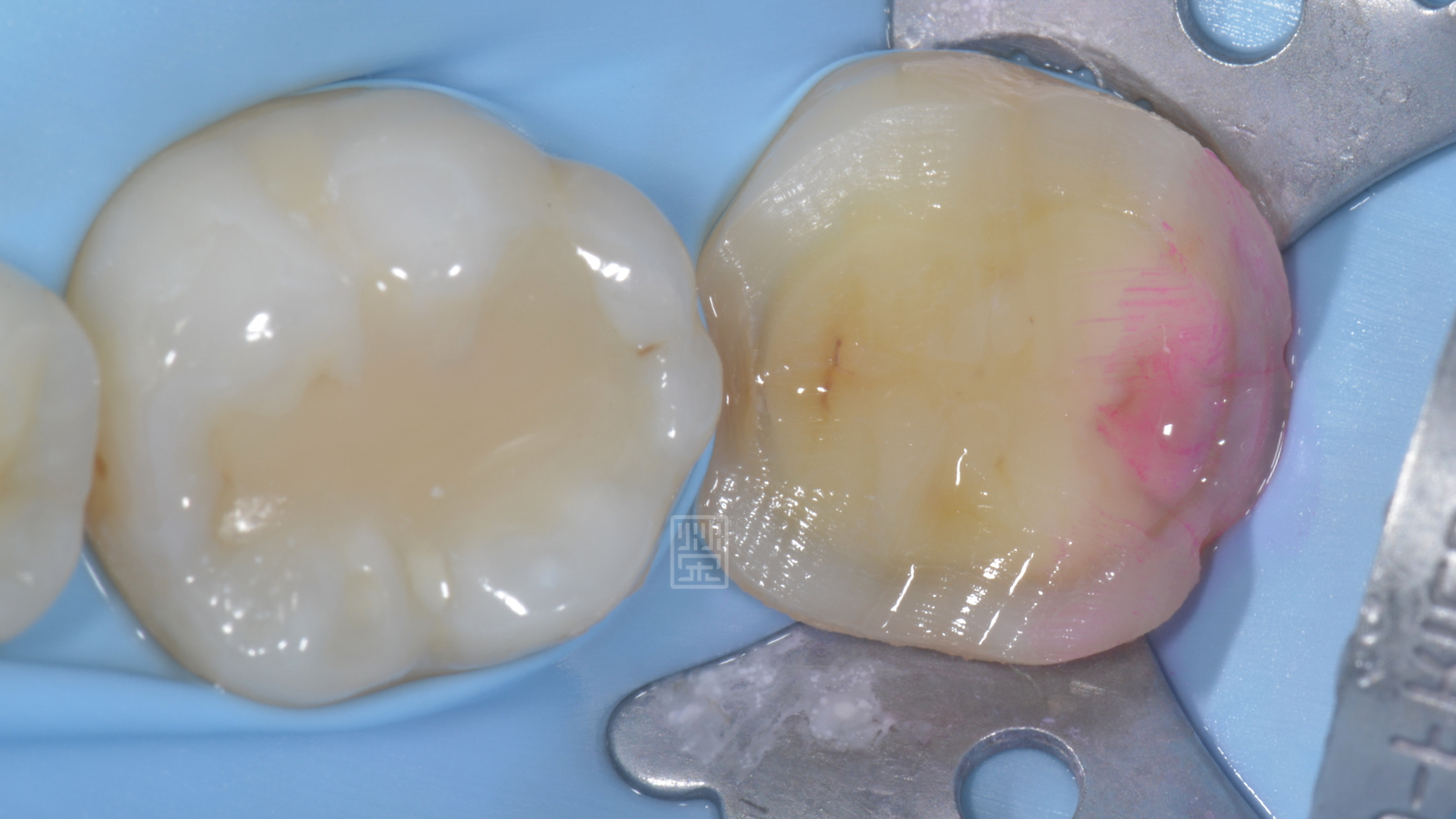 染色劑發現牙齒有裂痕