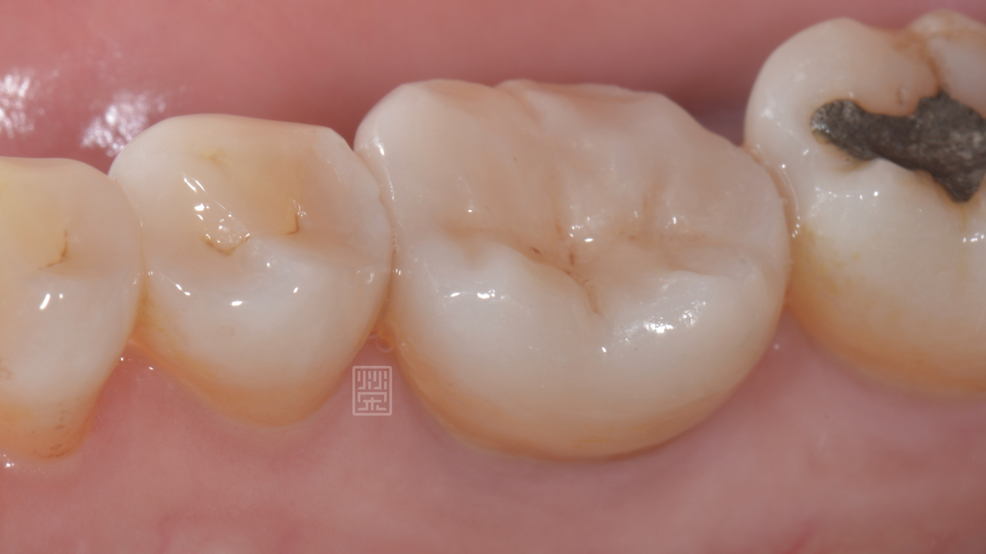 高雄牙醫，高雄牙齒重建，高雄植牙推薦|牙裂植牙重建案例-新悅美學牙醫診所