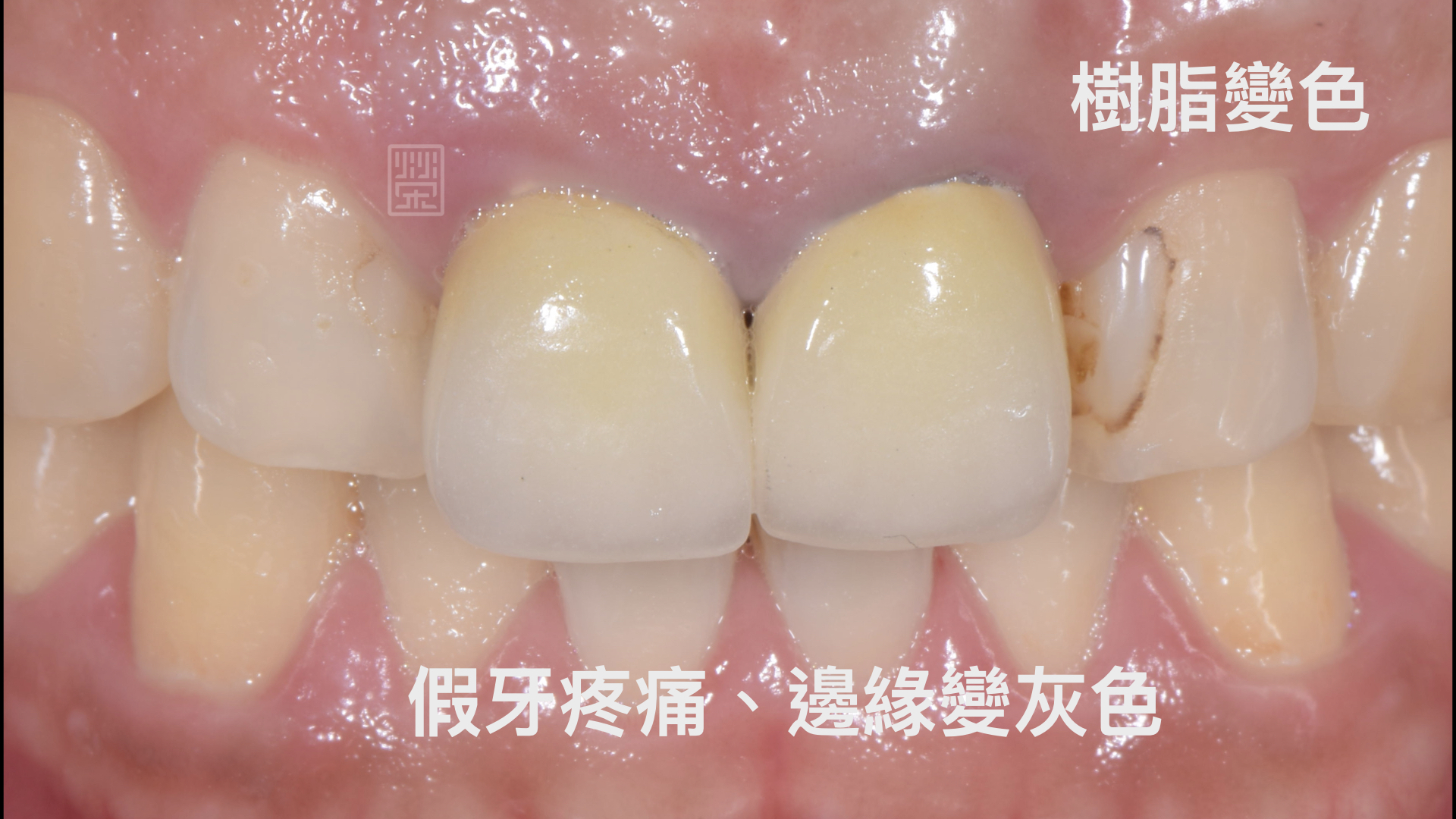 假牙邊緣變色、樹脂變色、牙齒變長