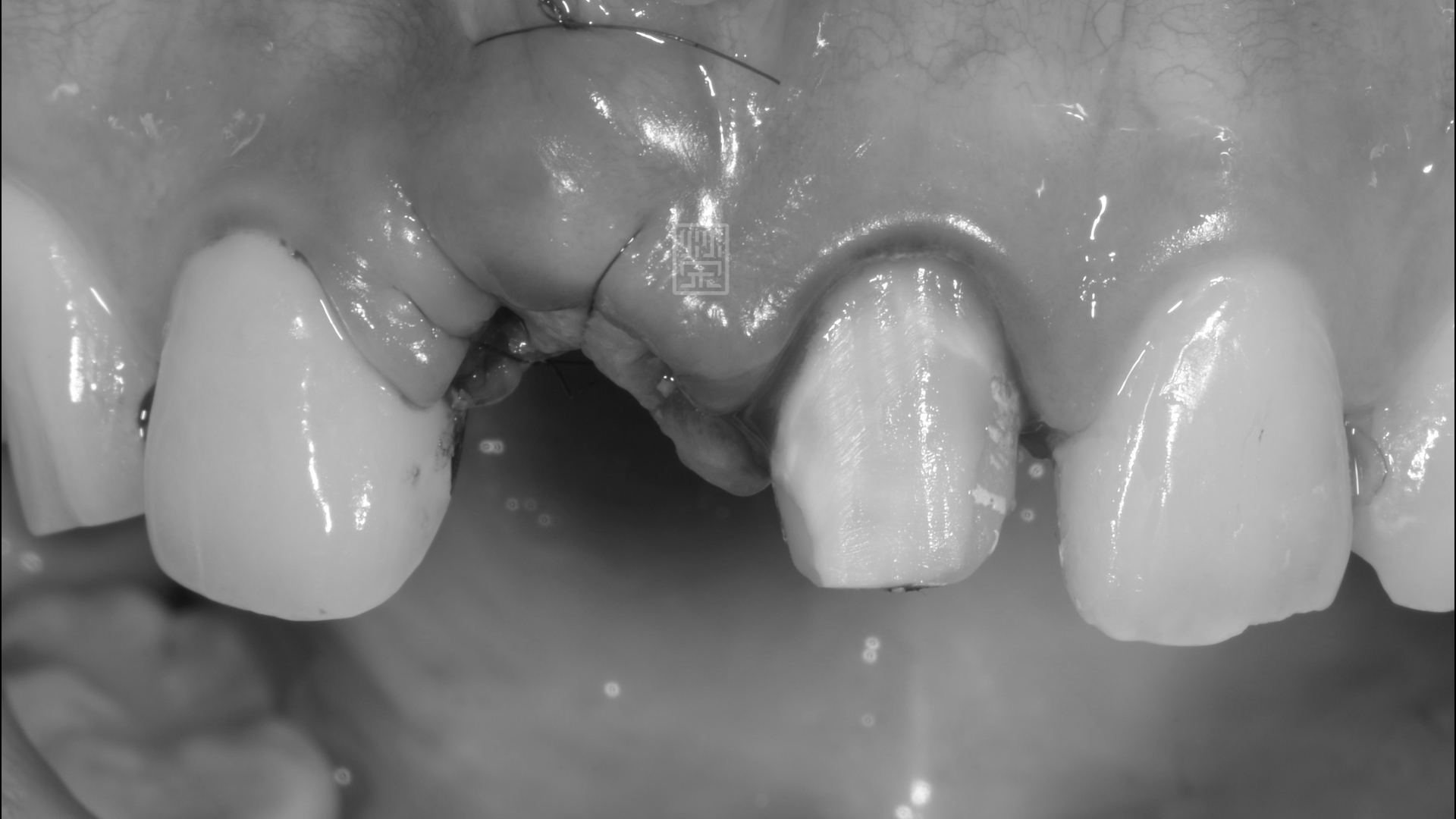 植牙手術合併牙齦轉移