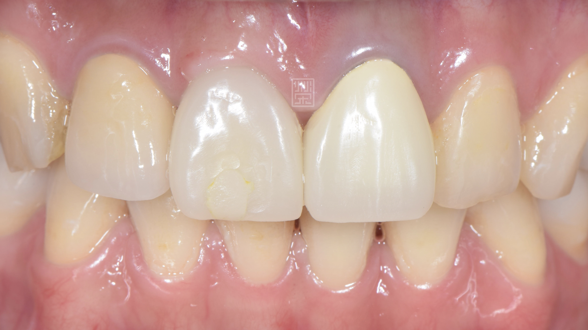 臨時假牙牙齦調整