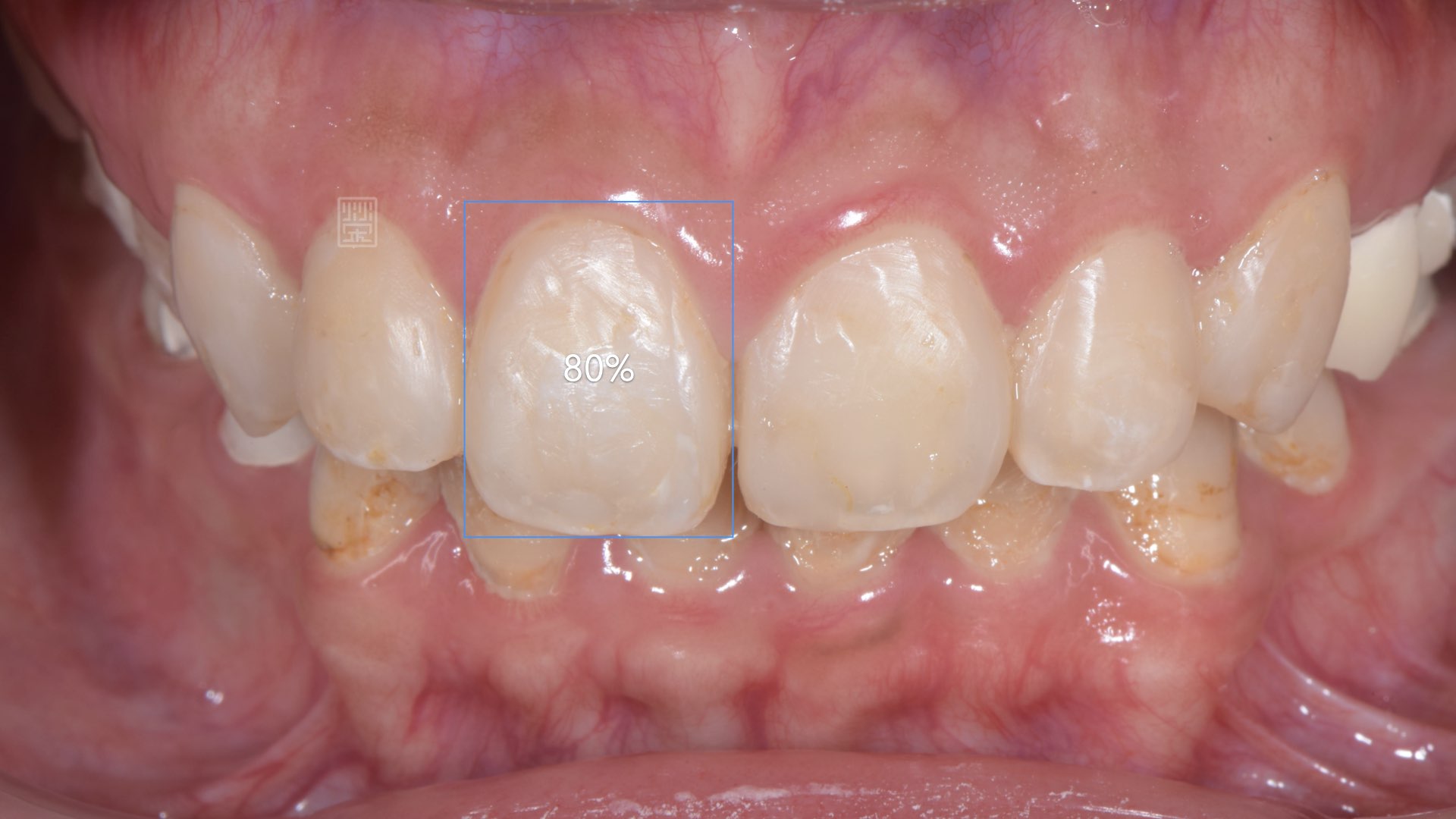 重新樹脂填補完畢，門齒比例80%，不宜做牙冠增常術