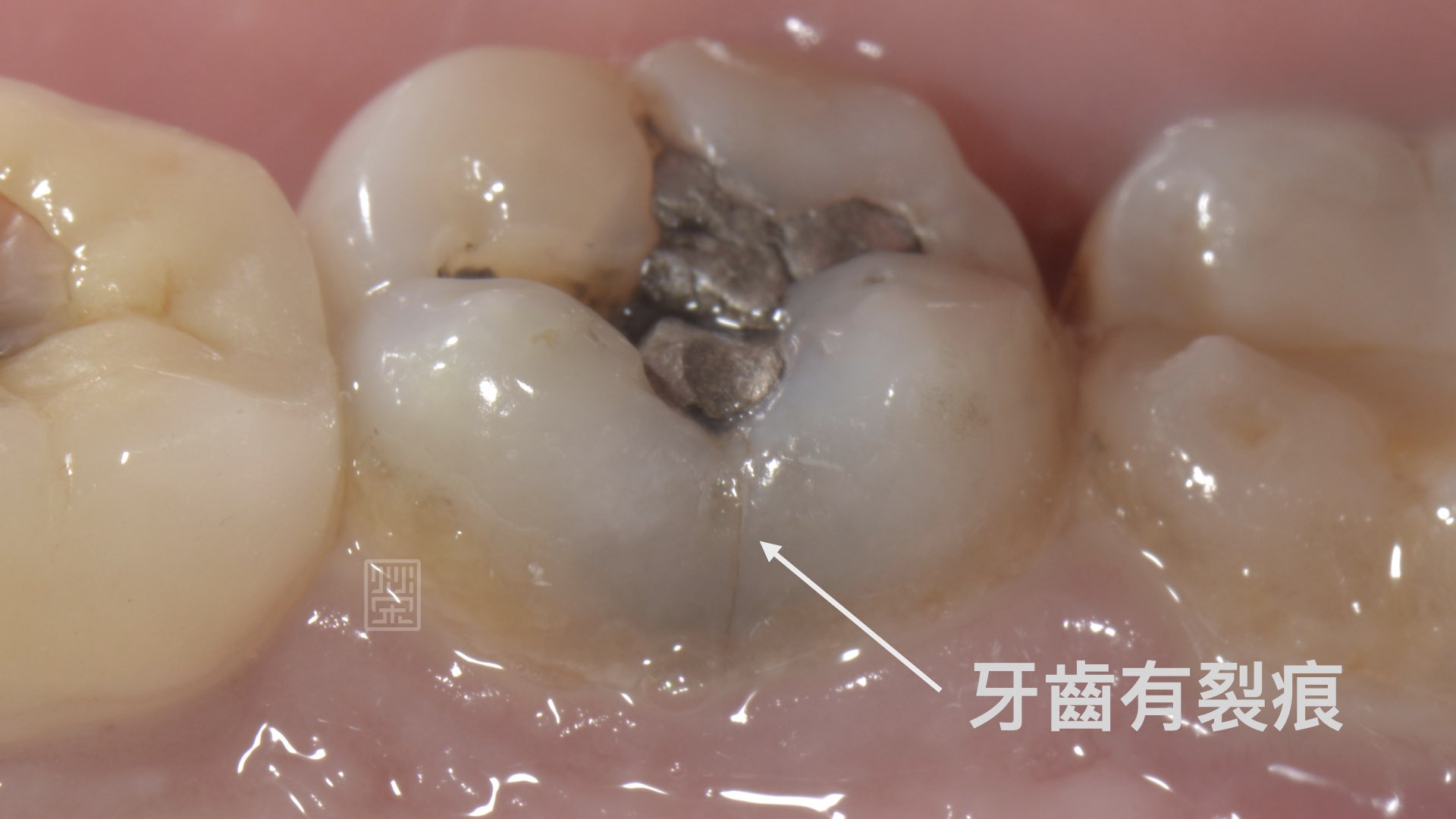 牙齿出现这种裂纹正常吗？专家告诉你什么情况才要去看医生 - 知乎