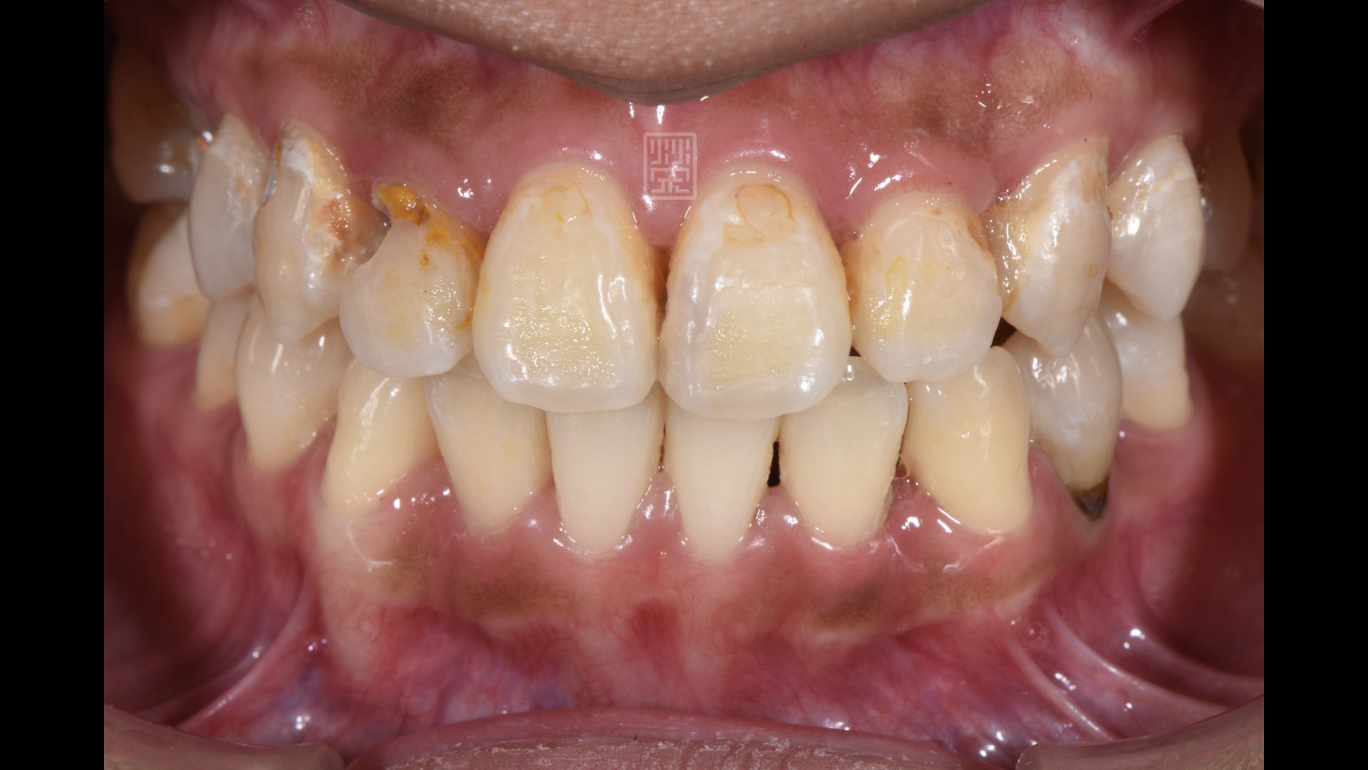 牙齒蛀牙造成牙髓神經發炎