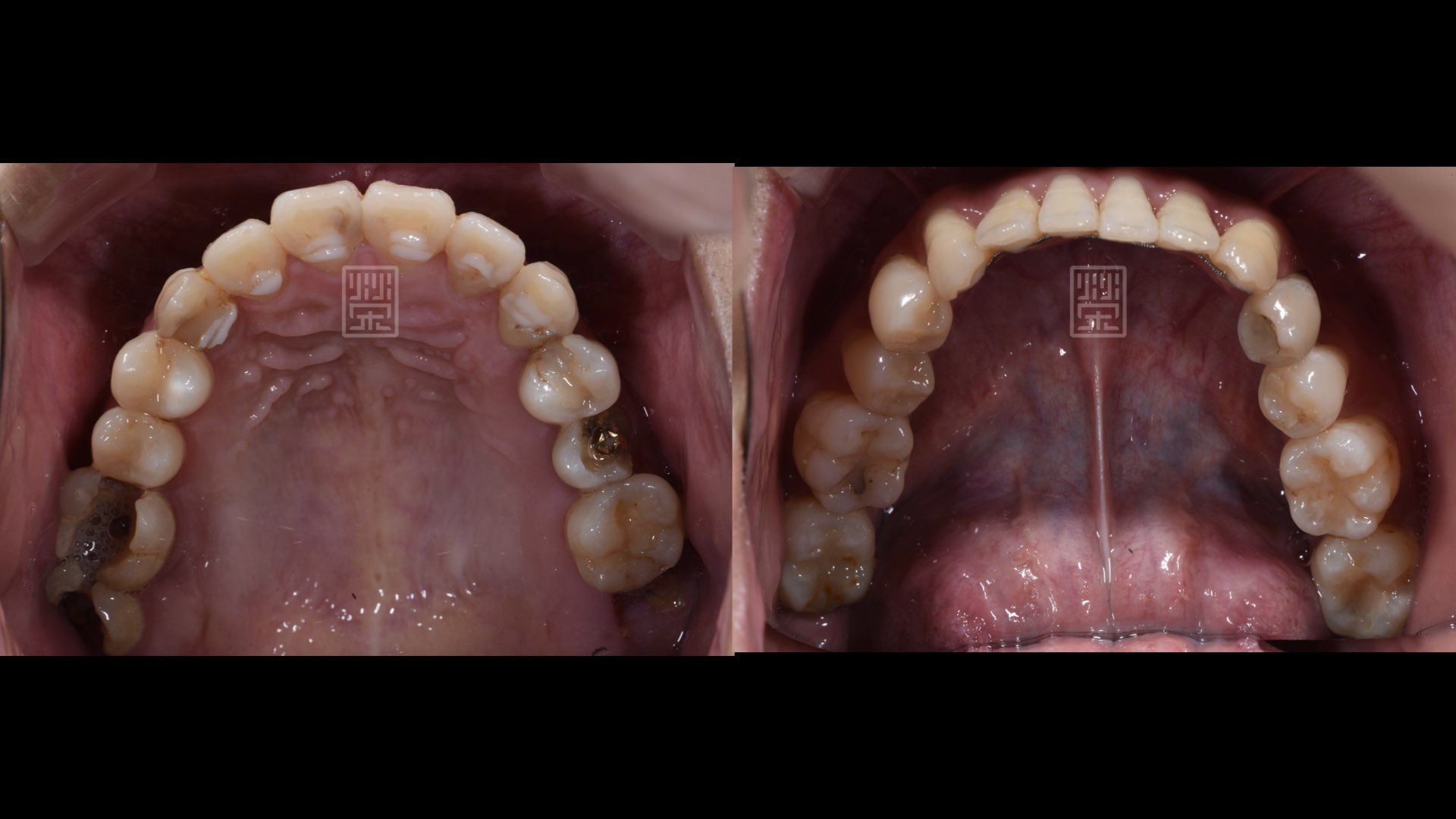 後方牙齒蛀牙斷裂