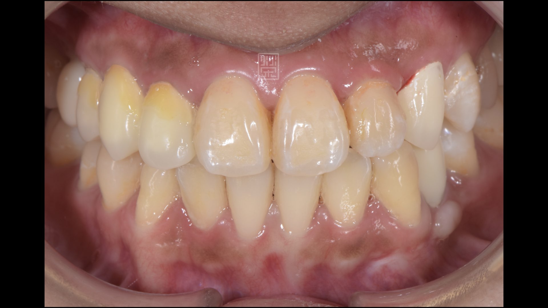 奈米樹脂、臨時假牙修復