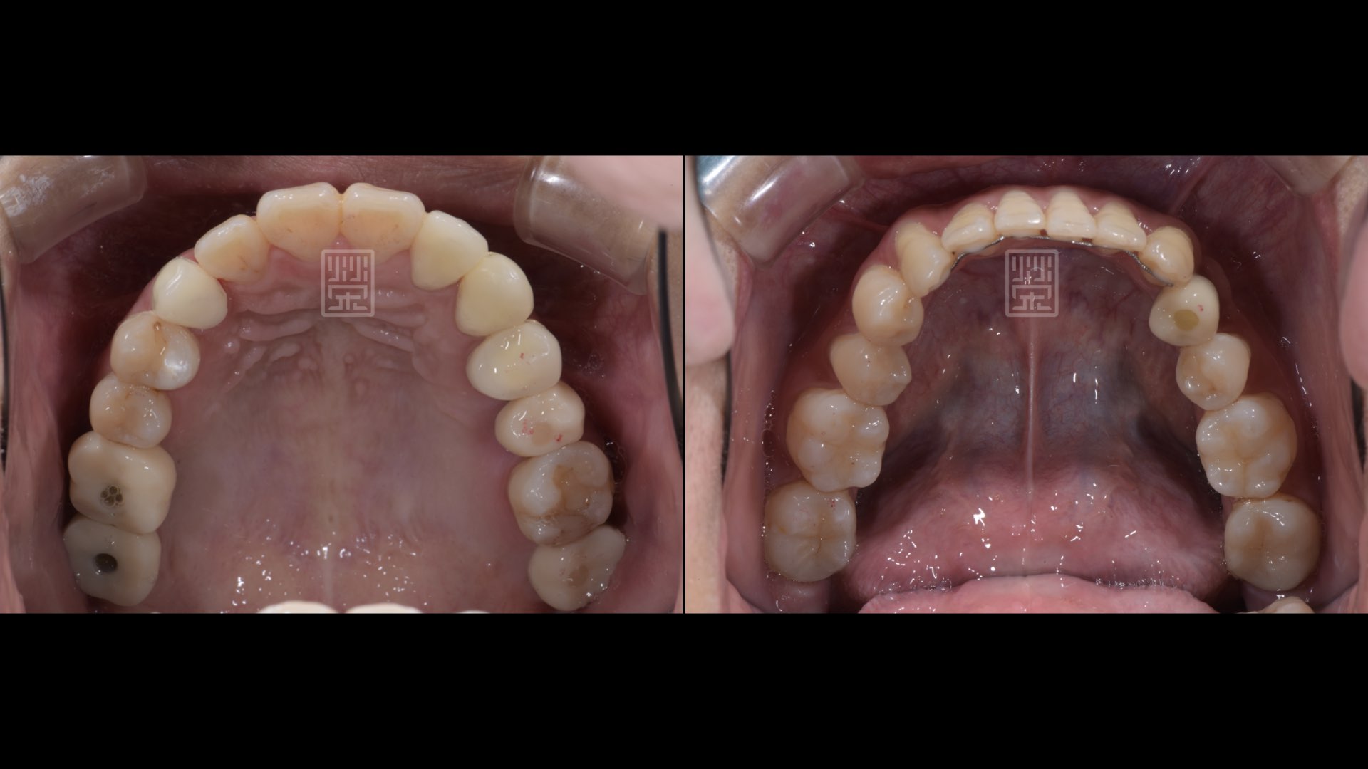 奈米樹脂、臨時假牙、植牙修復