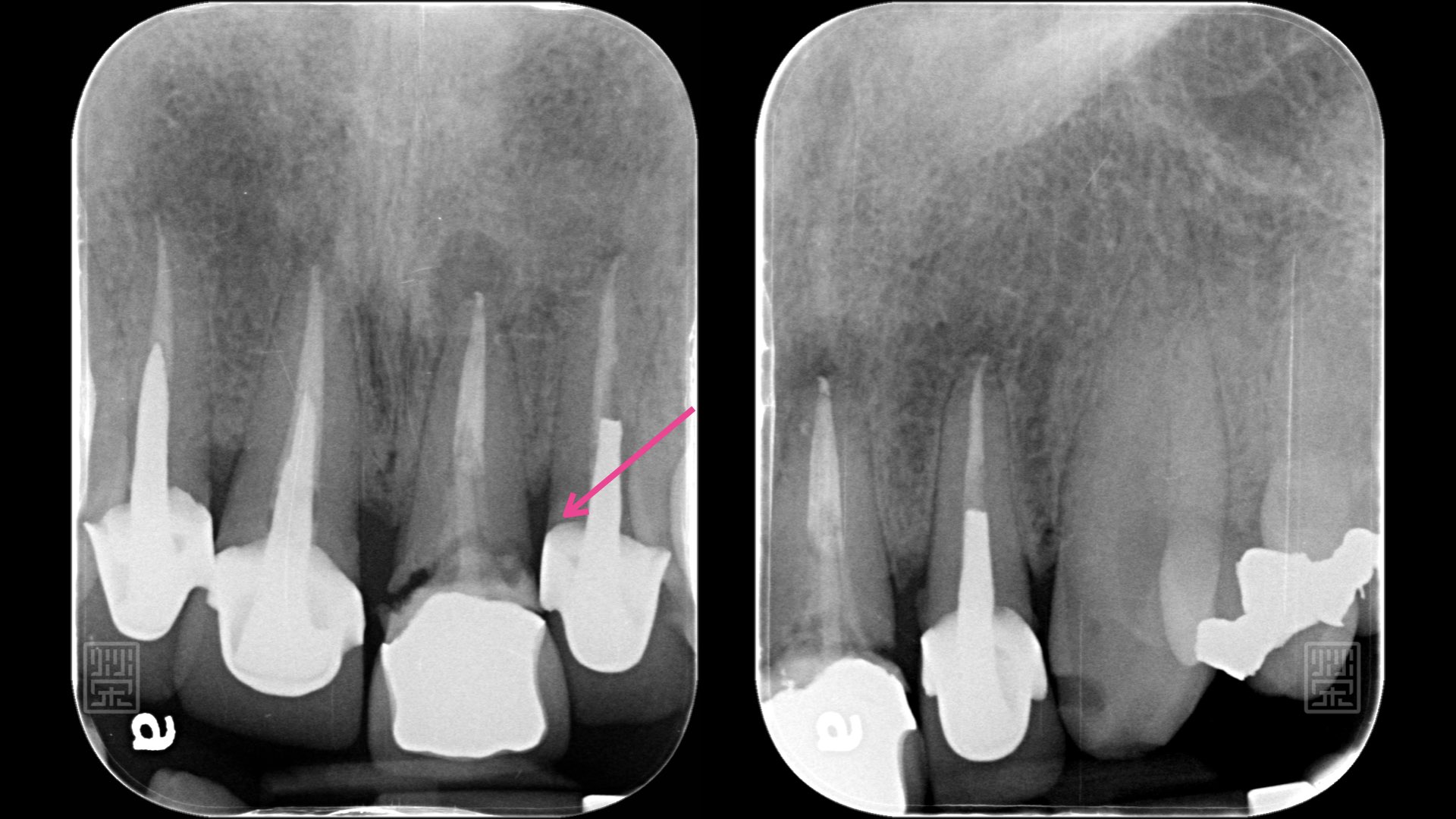 Ｘ光片明顯看到中門牙斷裂痕