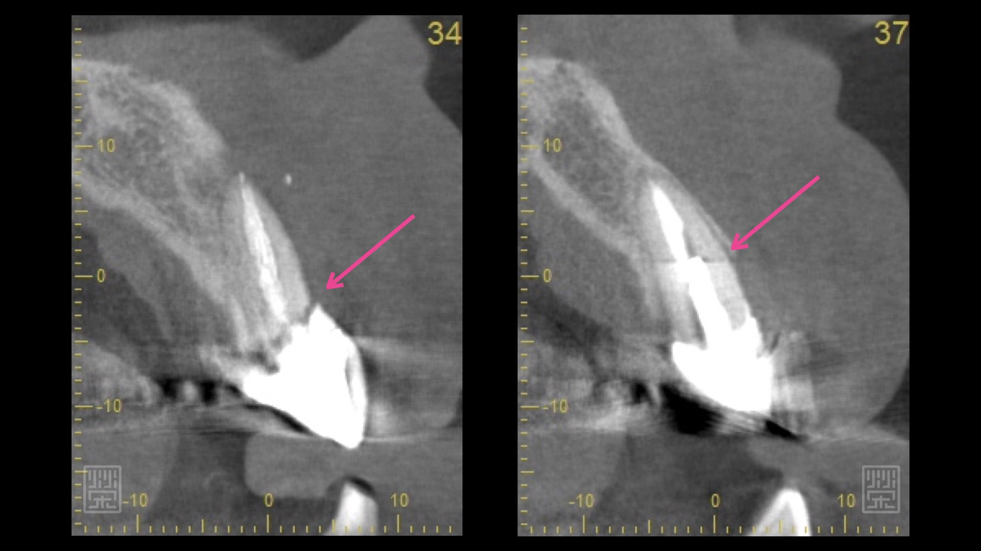 斷層掃描發現中門牙與側門牙都有斷裂痕