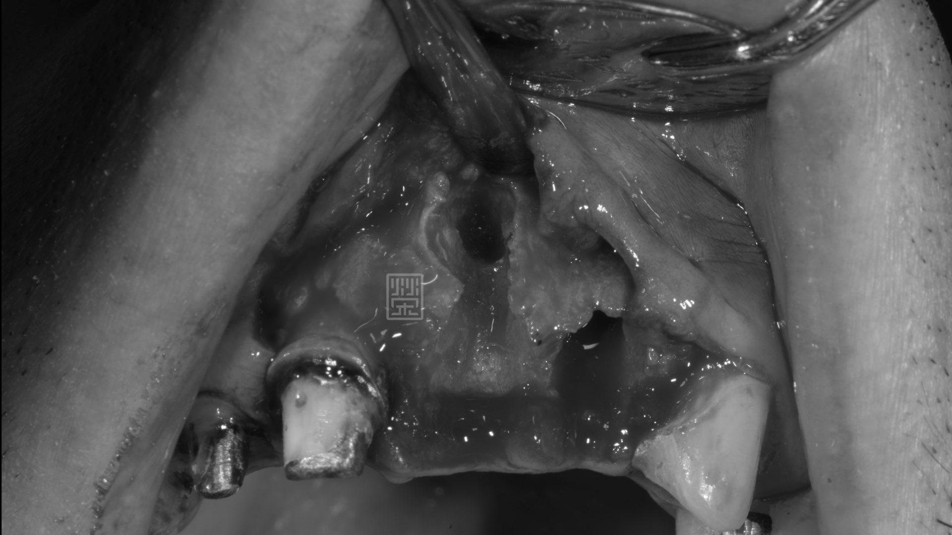 牙根拔除後，發現斷裂處骨頭嚴重缺損