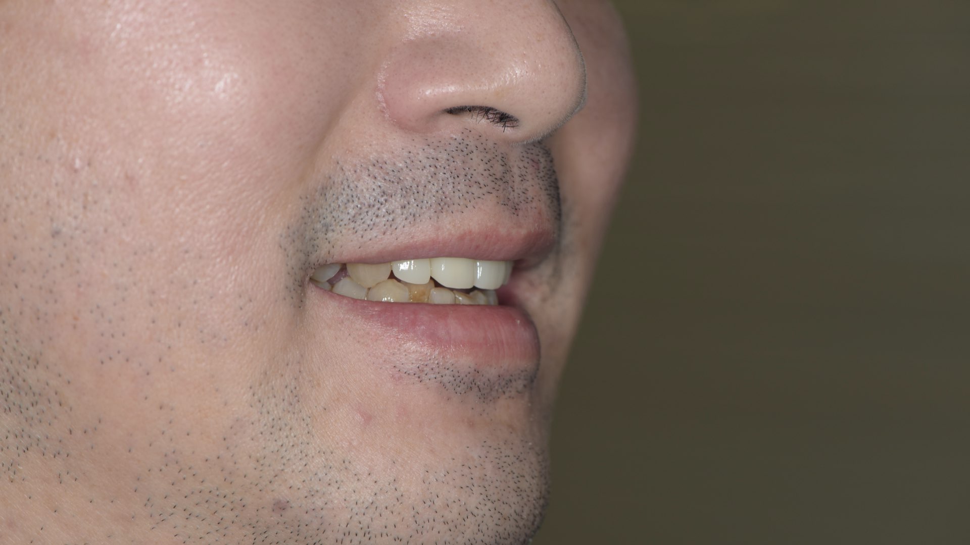 臨時假牙功能發音測試