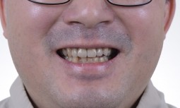 門牙晃得好厲害，原來牙齒斷掉了!!!---植牙合併全瓷冠改善咬合治療