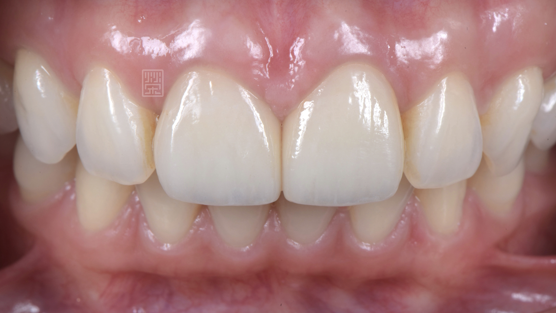 門牙全瓷冠修復，恢復牙齦健康與關閉牙縫
