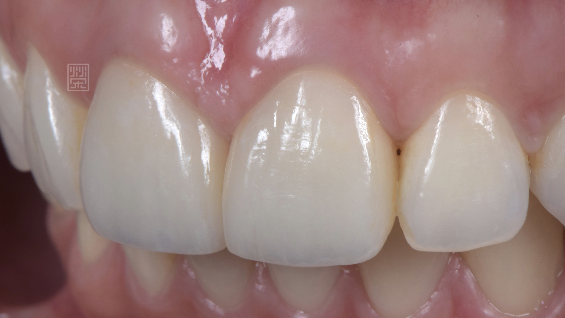 門牙全瓷冠修復，恢復牙齦健康與關閉牙縫