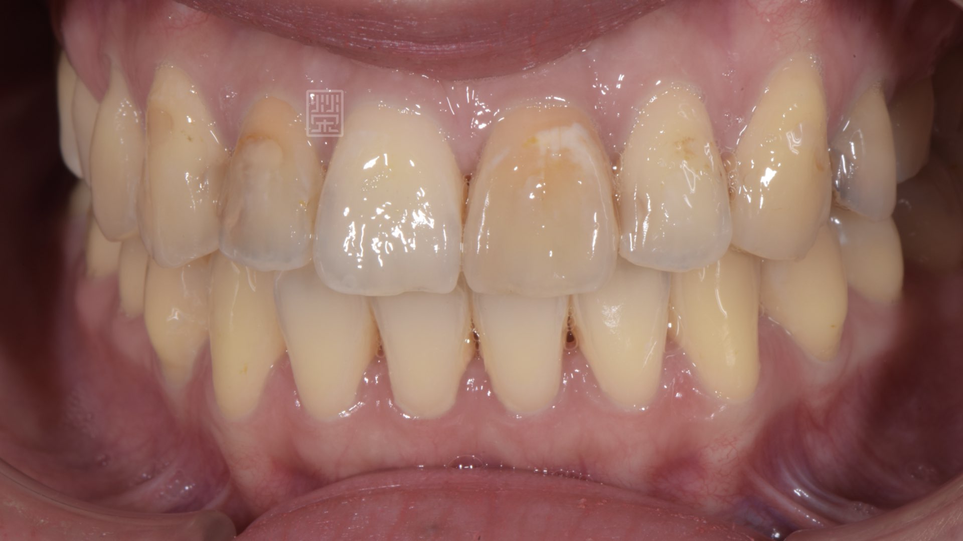 根管治療後牙齒變色