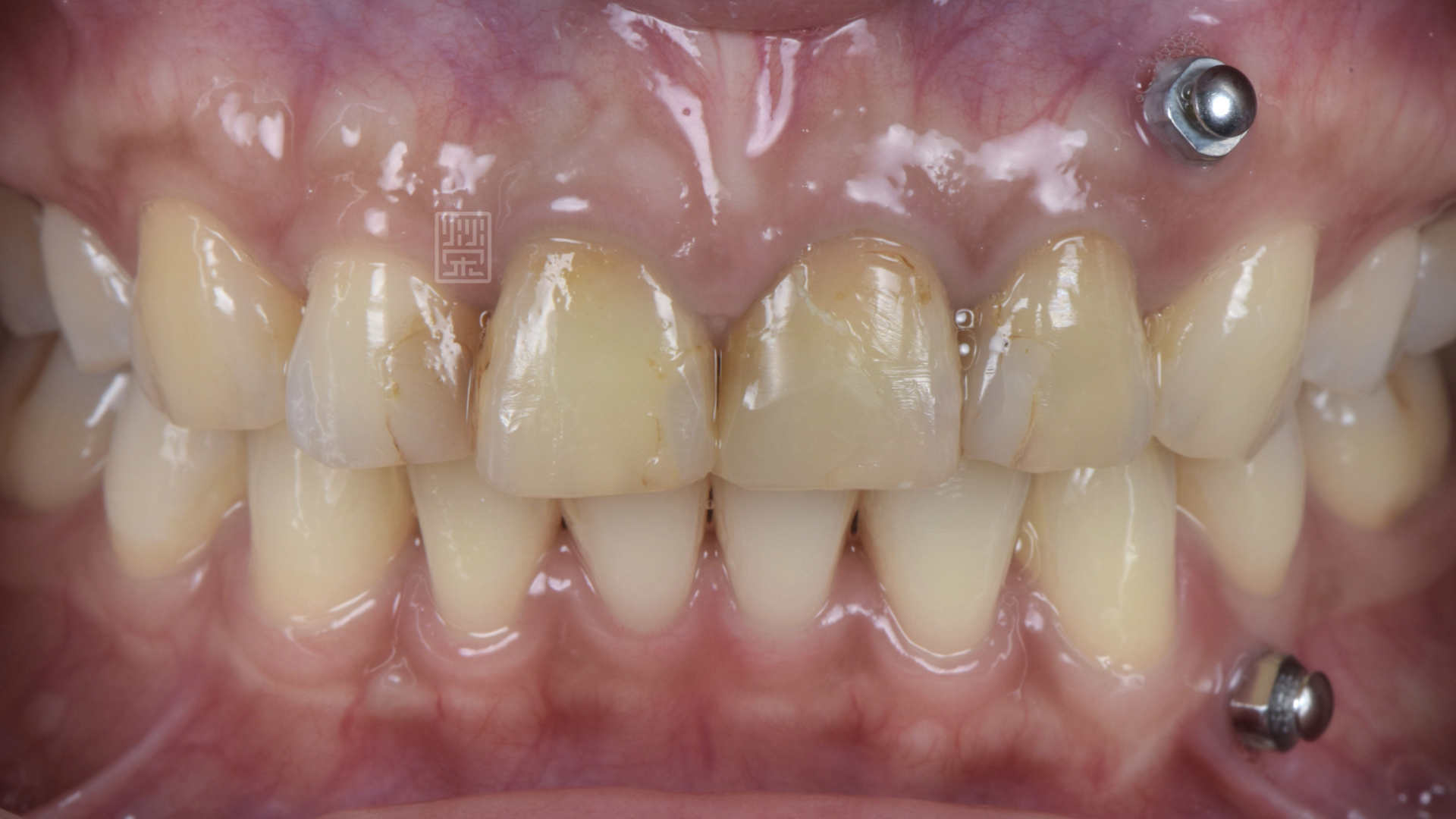 根管治療與樹脂填補後，牙齒顏色偏黃