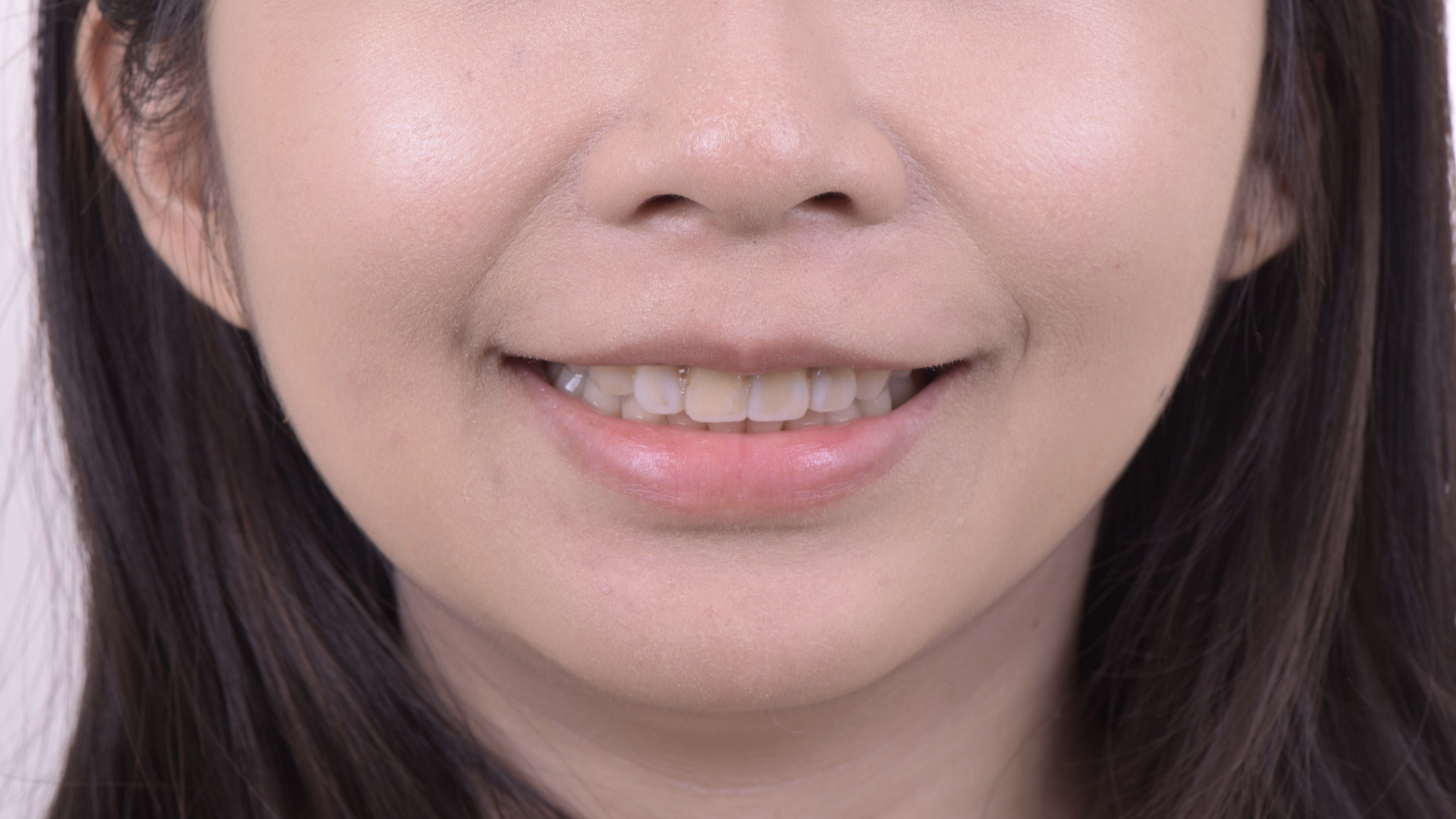 數位微笑模擬，將牙齒加長，更符合微笑曲線