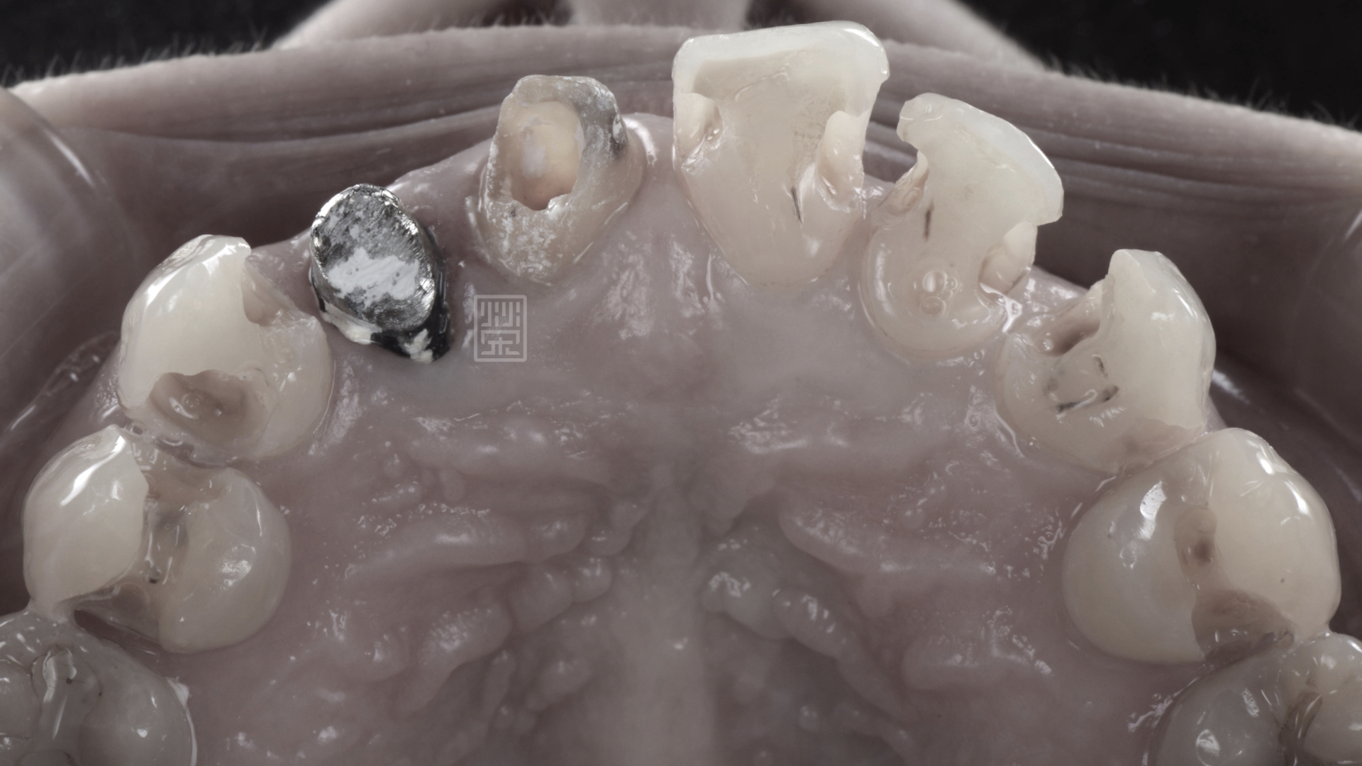 前牙蛀牙清除後齒質受損嚴重